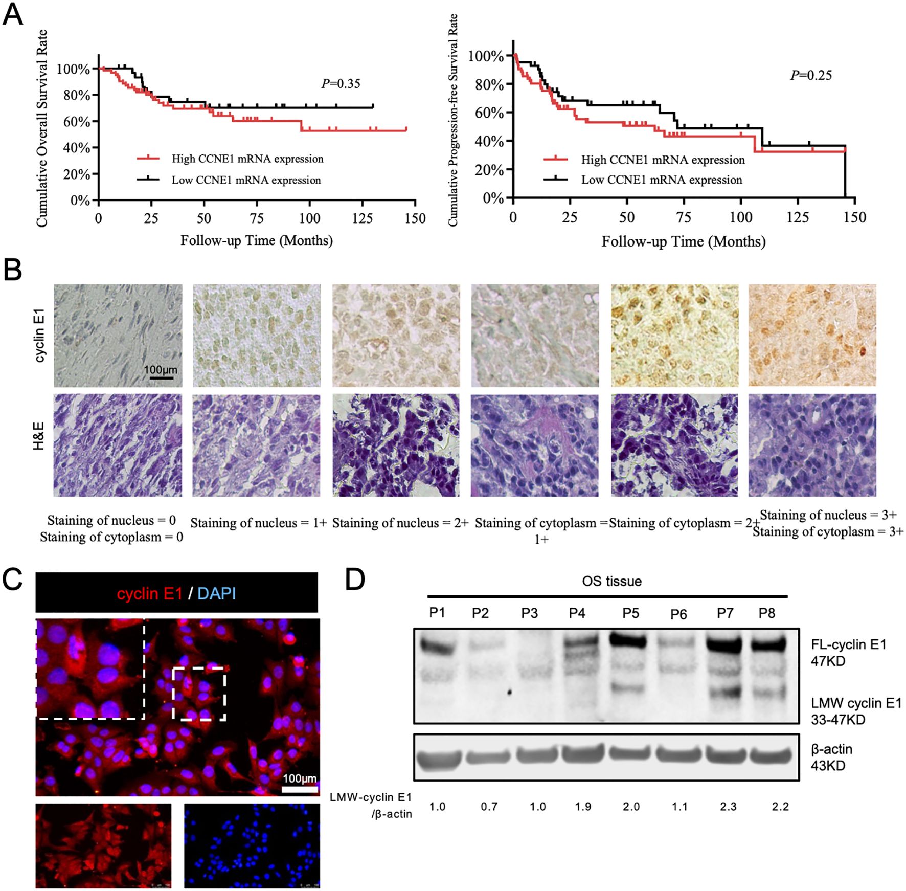 Panel A shows two Kaplan-Meier survival plots comparing high and low CCNE1 mRNA expression in cumulative overall survival and progression-free survival rates over 150 months, with p-values of 0.35 and 0.25. Panel B includes microscopic images showing cyclin E1 and H&E stained tissues with varying nucleus and cytoplasm staining intensities. Panel C features an immunofluorescence image with cyclin E1 in red and DAPI in blue. Panel D presents a Western blot analysis of cyclin E1 and β-actin in osteosarcoma tissues, with molecular weights and expression ratios provided.