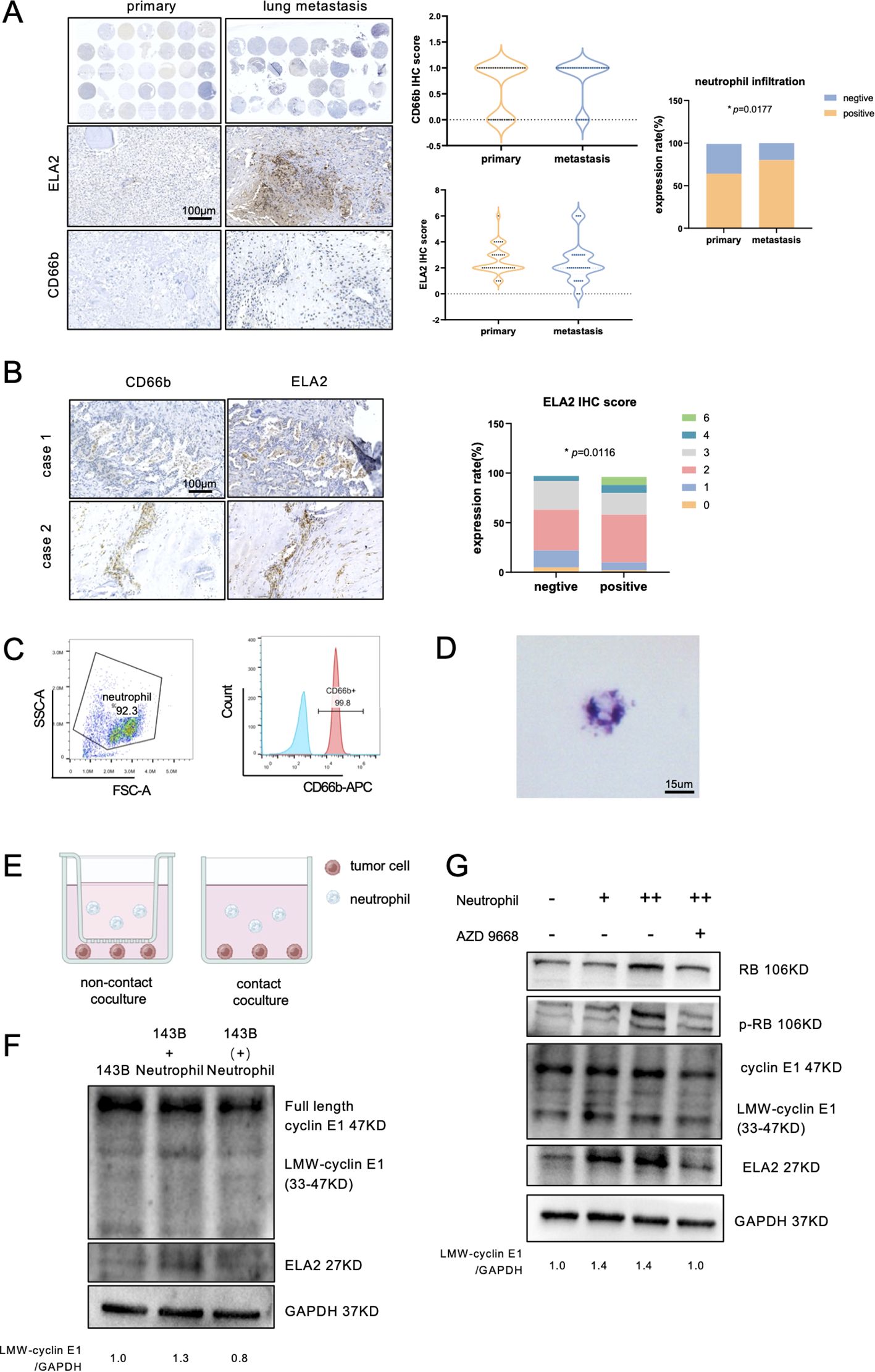The image consists of multiple panels labeled A to G. Panel A shows histological images of primary and lung metastasis tissues stained for ELA2 and CD66b, accompanied by violin plots and bar graphs depicting immunohistochemistry scores and neutrophil infiltration rates. Panel B displays two cases with ELA2 and CD66b staining, with a bar chart showing ELA2 expression rates. Panel C includes flow cytometry plots identifying neutrophils. Panel D is a microscopic image of a cell. Panel E illustrates non-contact and contact coculture setups of tumor cells and neutrophils. Panels F and G show Western blot analyses of protein levels in various experimental conditions.