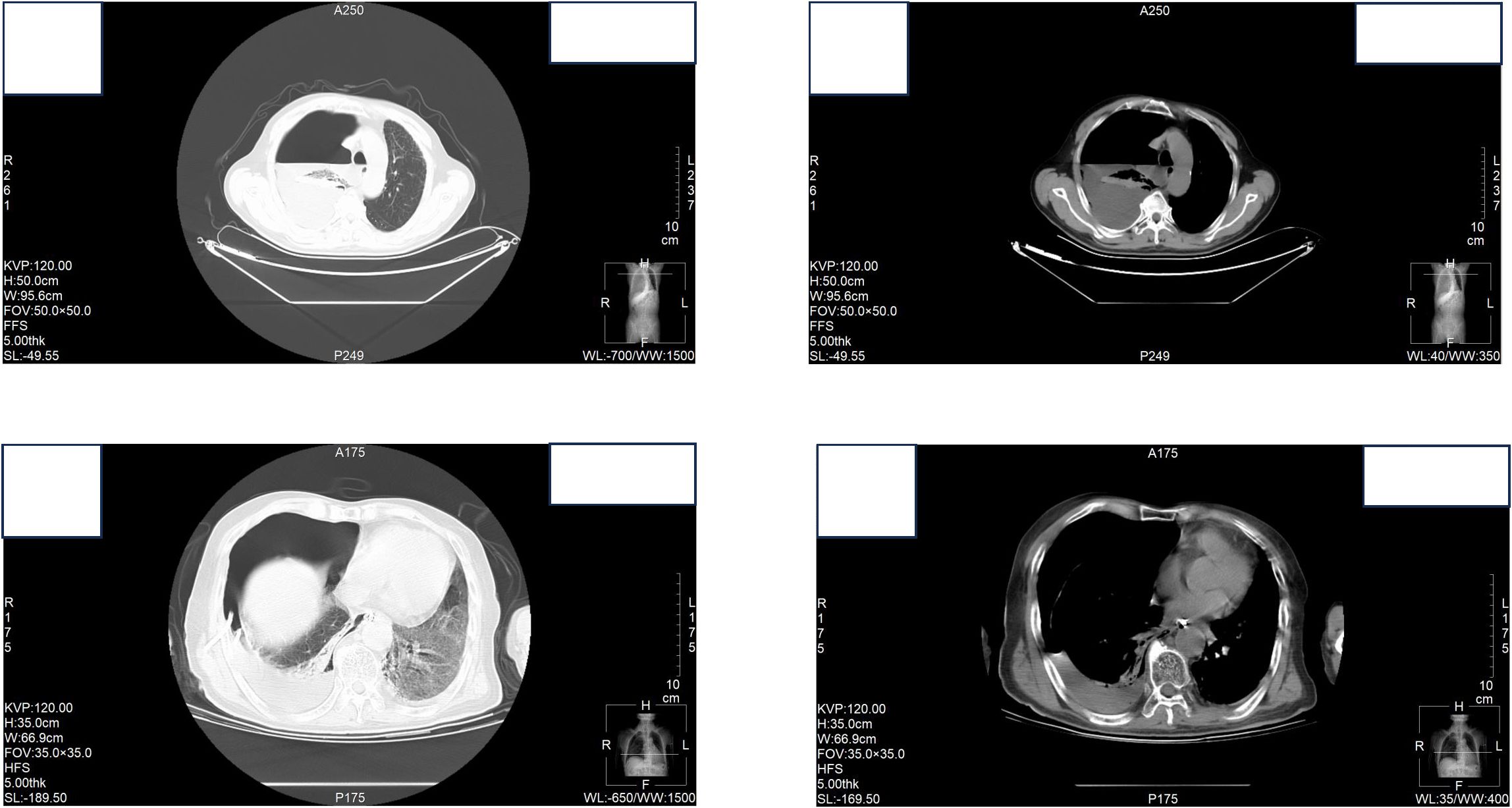 CT scans of a thorax in four panels showing different cross-sectional views. The top two panels display slices labeled A250, with clear depiction of lung structures. The bottom two panels, labeled A175, offer additional views with detailed visibility of thoracic organs. Both sets include measurement scales and technical data including KVP, slice thickness, and dimensions.