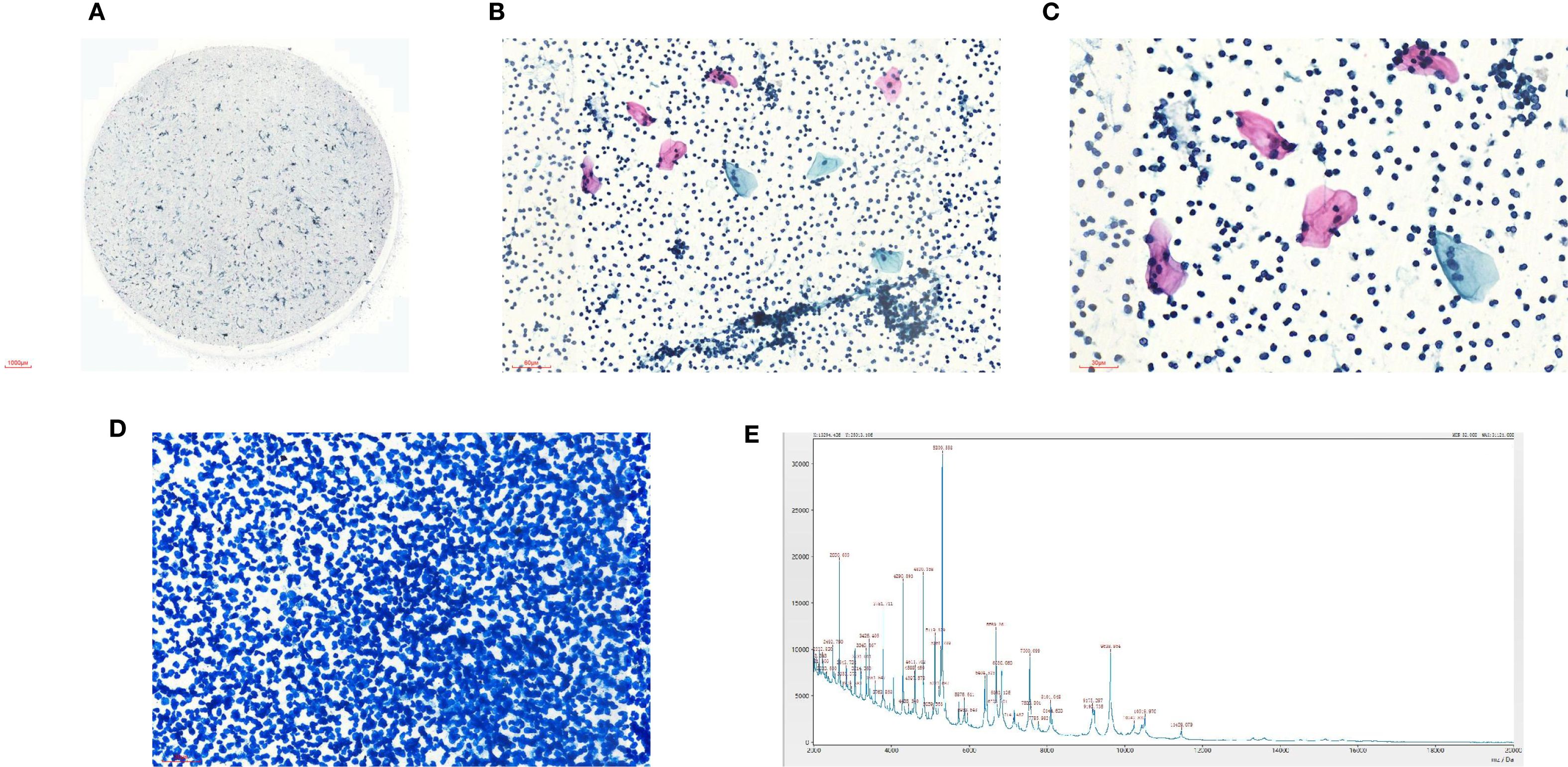 Five-panel image of histological and graphical data. Panel A shows a circular tissue sample with sparse blue dots. Panel B displays a section with scattered blue dots and some pink and blue-stained cells. Panel C highlights similar cells as Panel B with a closer view. Panel D features densely packed blue dots. Panel E is a graph with multiple peaks, potentially representing data analysis.