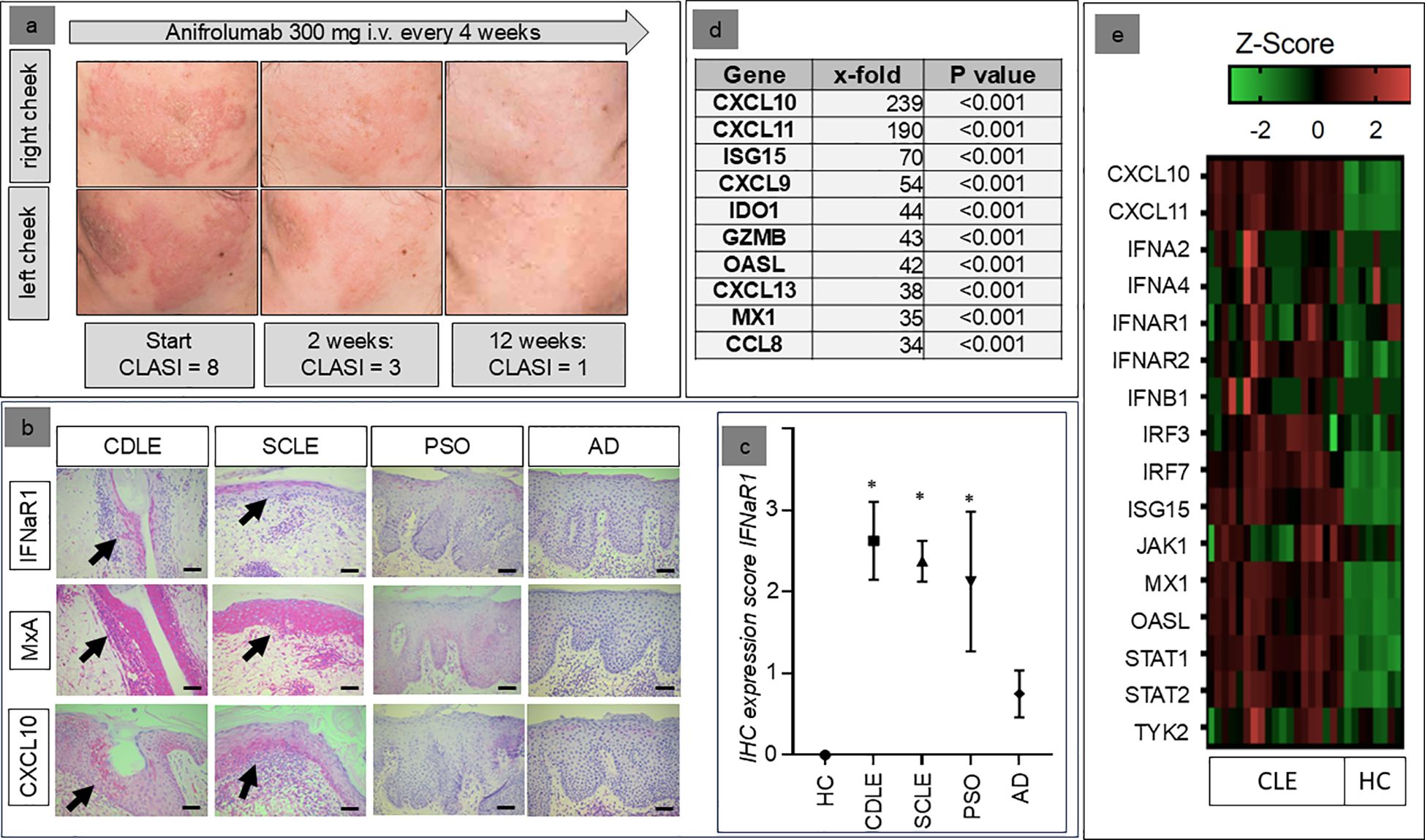 Panel a shows sequential images of cheeks treated with Anifrolumab, showing improvement in CLASI scores from 8 to 1 over 12 weeks. Panel b displays skin biopsy images with various markers across CDLE, SCLE, PSO, and AD conditions. Panel c is a chart comparing mean expression scores of IFNAR1 across different conditions, with CDLE, SCLE, and PSO showing higher scores. Panel d lists gene expressions with x-fold changes and P values, showing significant increases for genes like CXCL10. Panel e is a heatmap of Z-scores for multiple genes, indicating expression levels in CLE compared to HC.