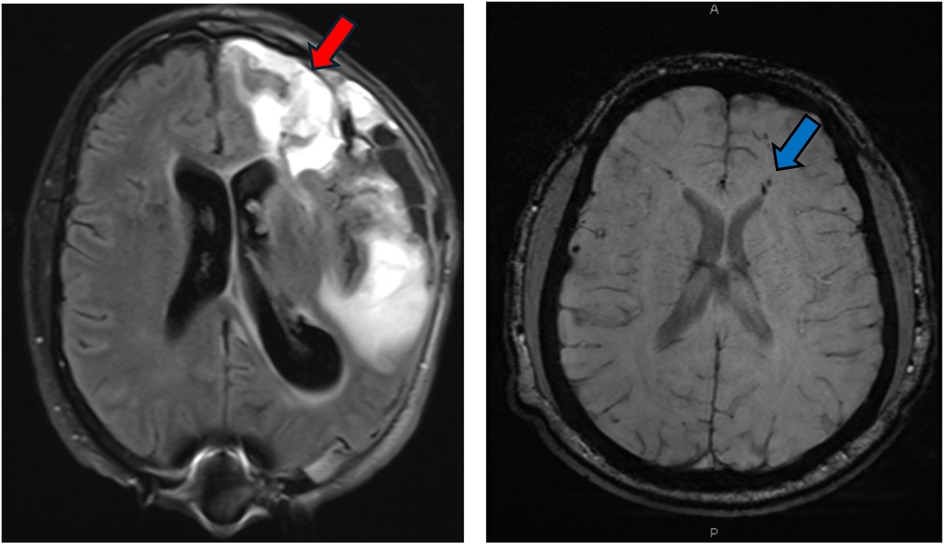 MRI scans displaying two axial cross-sections of a brain. The left image shows a bright area highlighted by a red arrow, suggesting a potential abnormality. The right image, marked with a blue arrow, indicates another region of interest with less brightness compared to the first image.