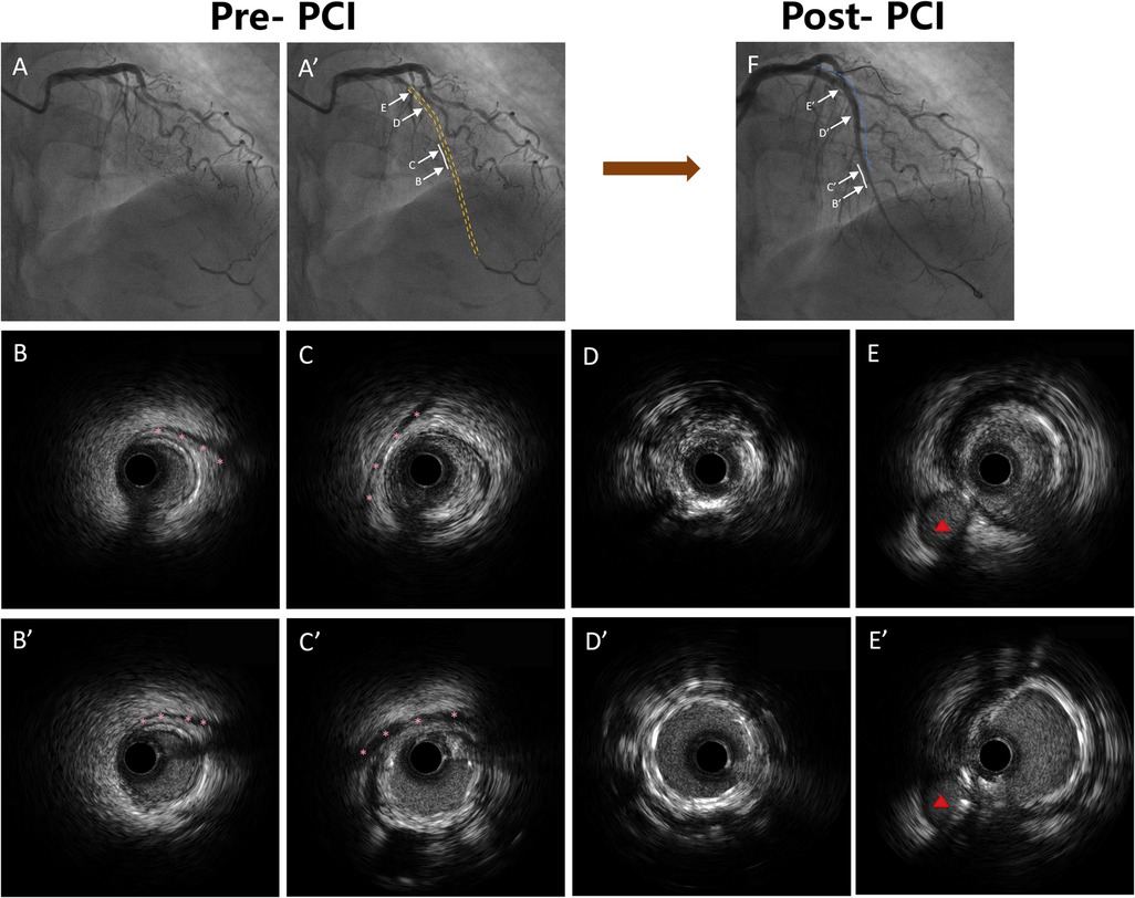 Pre- and post-PCI comparison showing angiograms and intravascular ultrasound images of coronary arteries. Images A and A' depict pre-PCI conditions with highlighted sections B, C, D, and E. Image F shows post-PCI conditions with corresponding sections B', C', D', and E'. Bottom panels include ultrasound cross-sections illustrating arterial changes, with red markers indicating plaque boundaries before and after PCI.