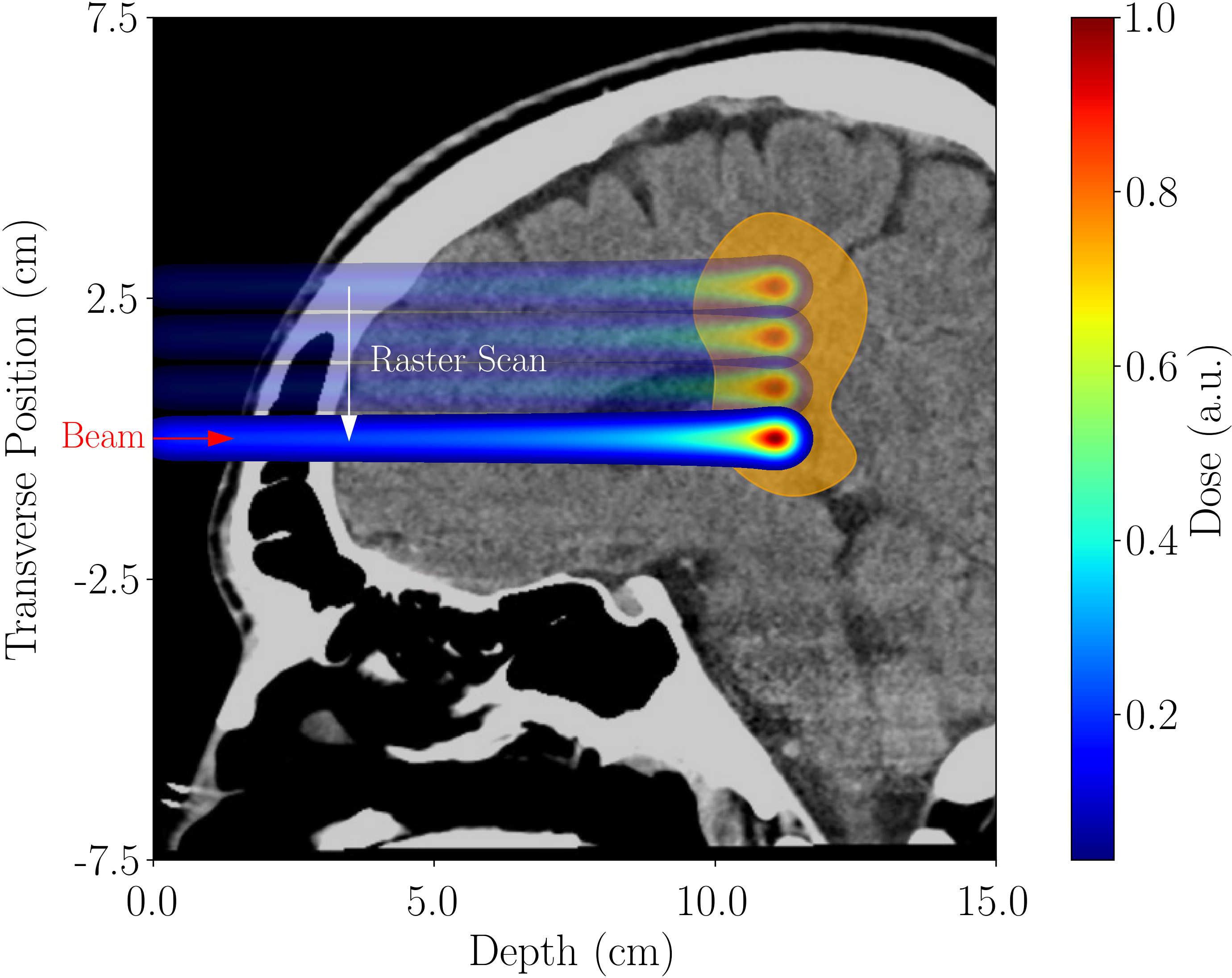 Medical image showing a cross-sectional view of a brain with a colored overlay representing a radiation dose distribution. A colored scale bar indicates dose intensity, with blue as low and red as high. The beam enters from the left, and the scan pattern is labeled as “Raster Scan.” Transverse position and depth are measured in centimeters.