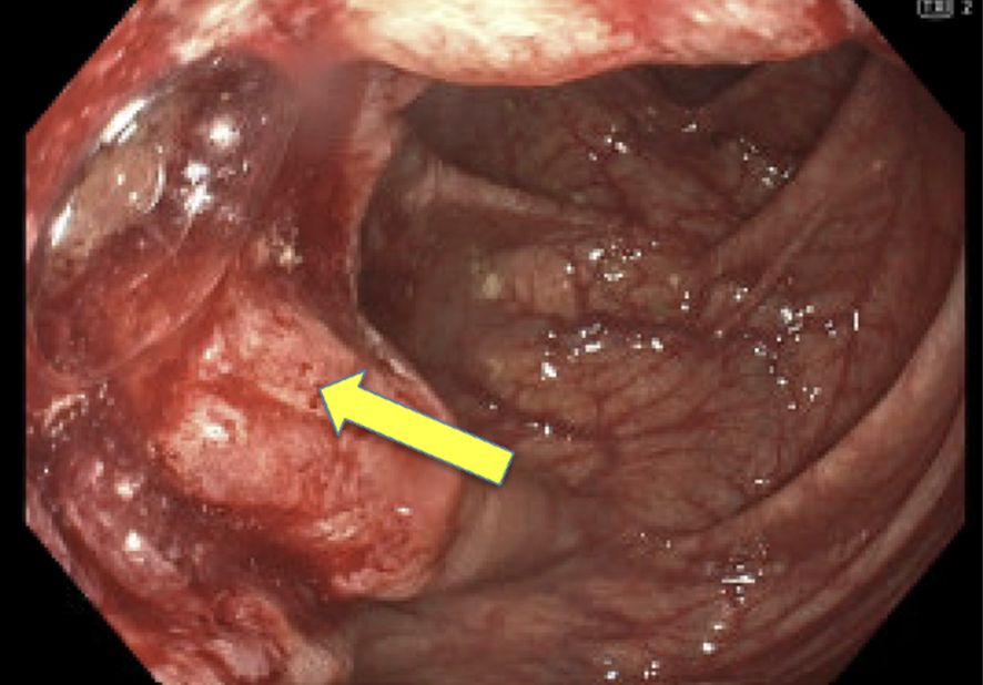 Endoscopic image showing the interior of the colon with a red, irregularly shaped mass identified by a yellow arrow, indicating an area of concern. The surrounding tissue appears moist and textured.