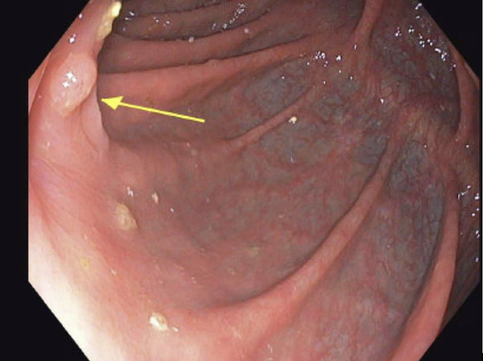 Endoscopic image showing the interior of the large intestine with a yellow arrow pointing to a small, raised area on the intestinal lining. The mucosa appears reddish and moist.