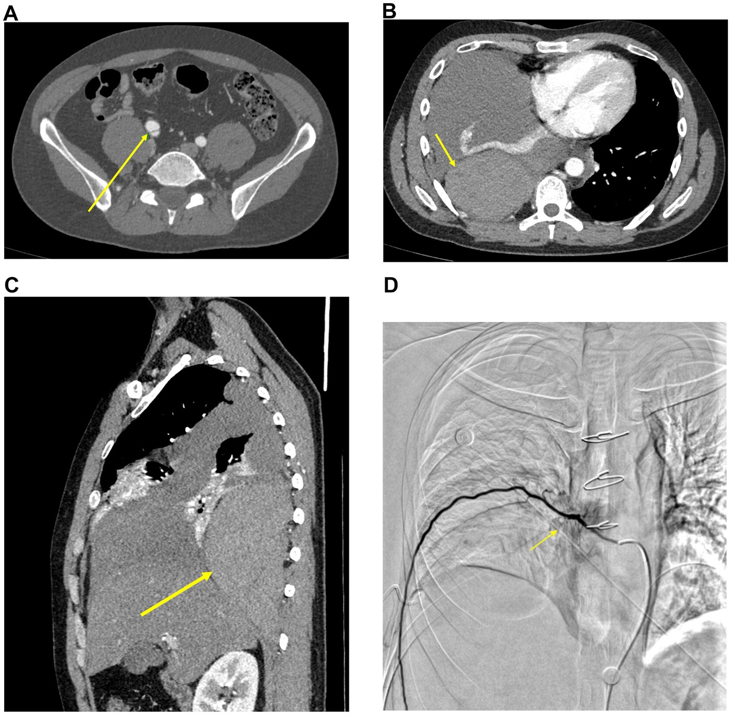 CT and angiographic images labeled A, B, C, and D. Image A shows an axial CT scan with a yellow arrow indicating a structure in the pelvic region. Image B displays an axial CT scan of the upper abdomen with a yellow arrow pointing to a specific area near the liver. Image C provides a sagittal CT view of the torso with a yellow arrow marking an area near the diaphragm. Image D is an angiogram with two yellow arrows indicating blood vessels in the upper thoracic region.