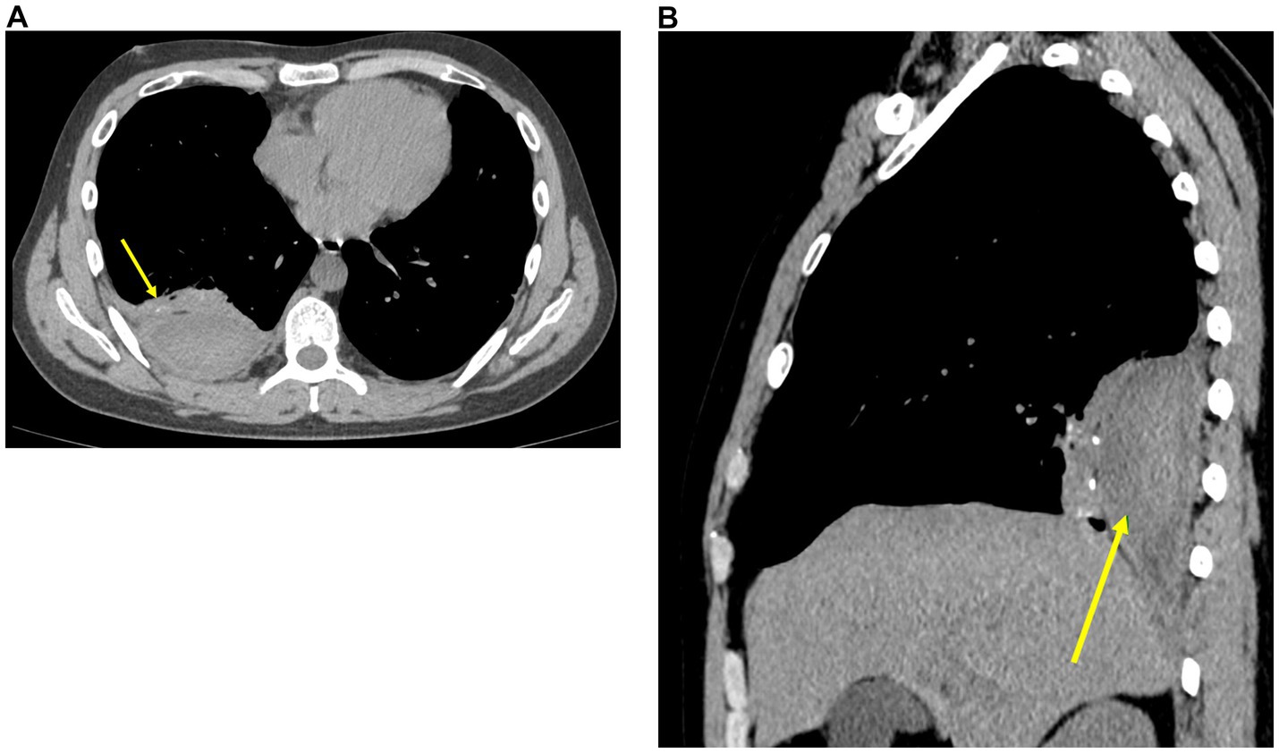 Two CT scan images are shown. Image A is an axial cross-section of the chest highlighting a lesion in the lower left lung with a yellow arrow. Image B is a sagittal view indicating the same lesion with a yellow arrow. Both images emphasize the location of the abnormality in the lung.