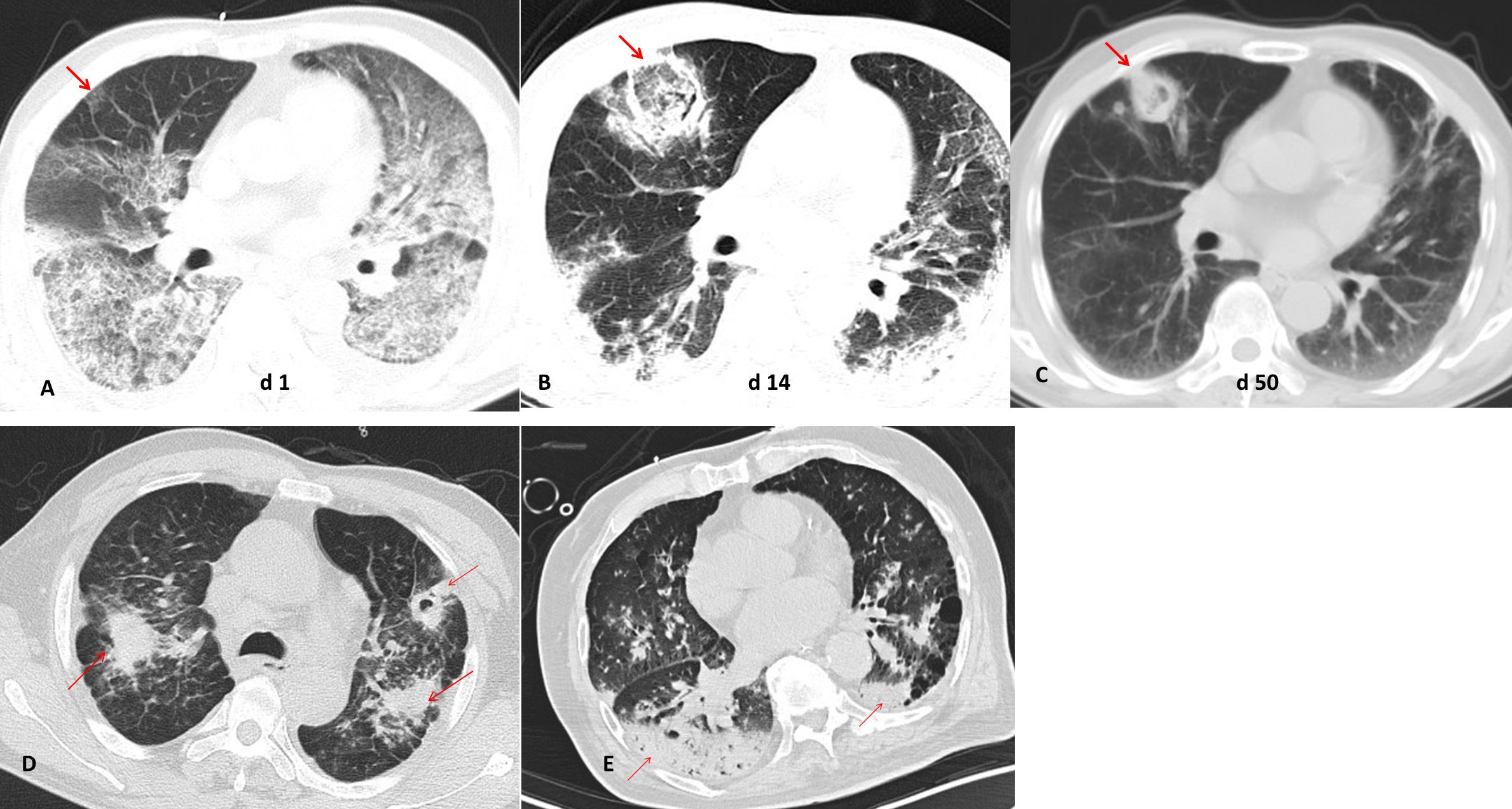 CT scans showing lung pathology over time. Image A (day 1) shows initial lung abnormalities with a red arrow pointing to affected areas. Image B (day 14) depicts increased opacification. Image C (day 50) shows a reduction in abnormal findings. Images D and E present lung conditions with several red arrows marking different affected areas, indicating persistent abnormalities.