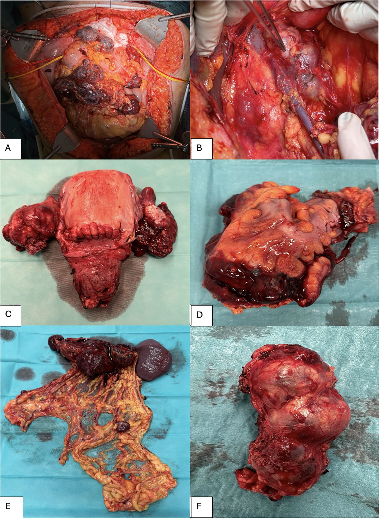 A series of six medical images showing various surgical and pathological aspects. Image A displays an open surgical eld with abdominal cavity. ImageB shows a close-up of pathologic lymph nodes. Image C depicts a dissected uterus with bilateral adnexa. Image D presents a resected rectosignomid colon. Image E shows dissected tissue with parts of omentum and spleen. Image F displays a Resected lymph node package.