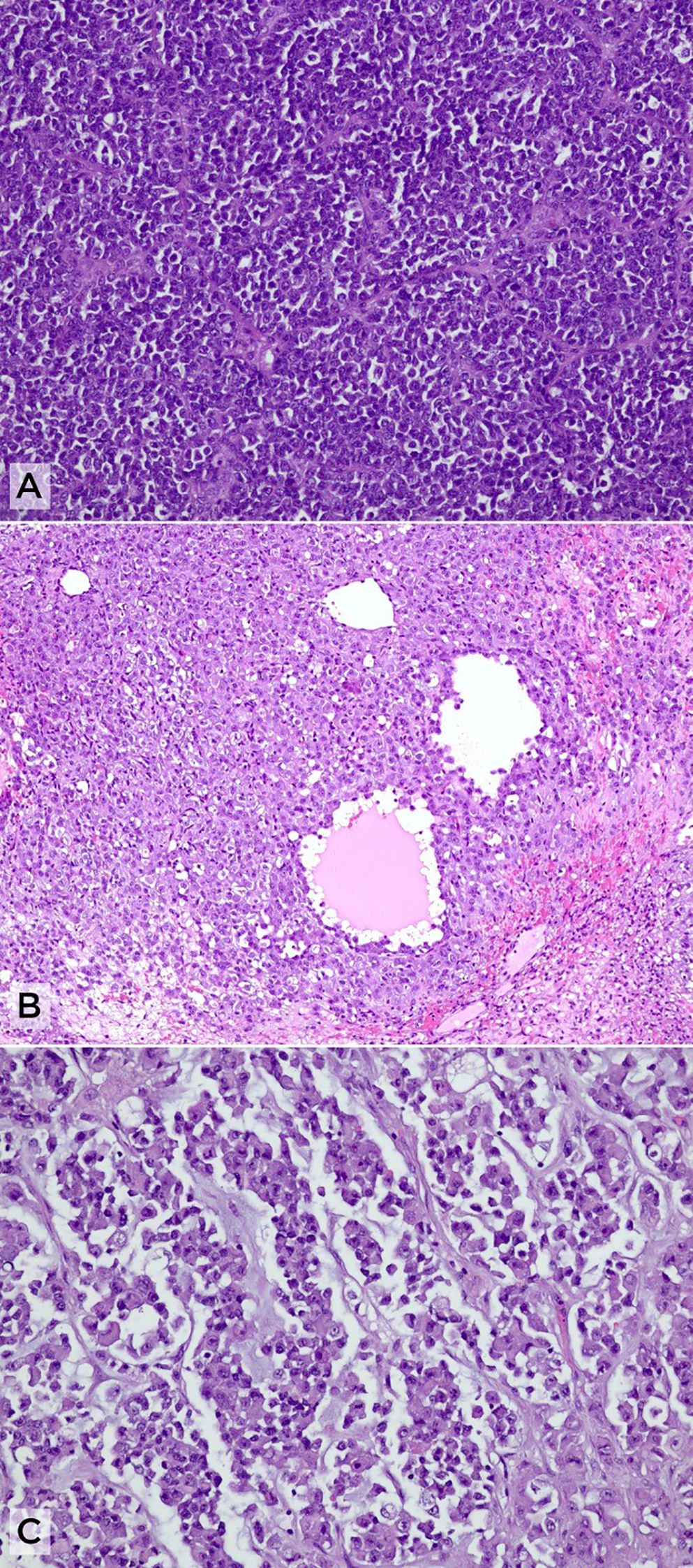 Three microscopy images labeled A, B, and C depicting different cellular structures in purple and pink hues. Image A shows densely packed round-to-oval cells. Image B highlights pseudofollicular arrangements surrounded by a population of larger cells with more abundant cytoplasm. Image C displays a rhabdoid morphology with eccentric nuclei and abundant eosinophilic cytoplasm in a myxoid background.
