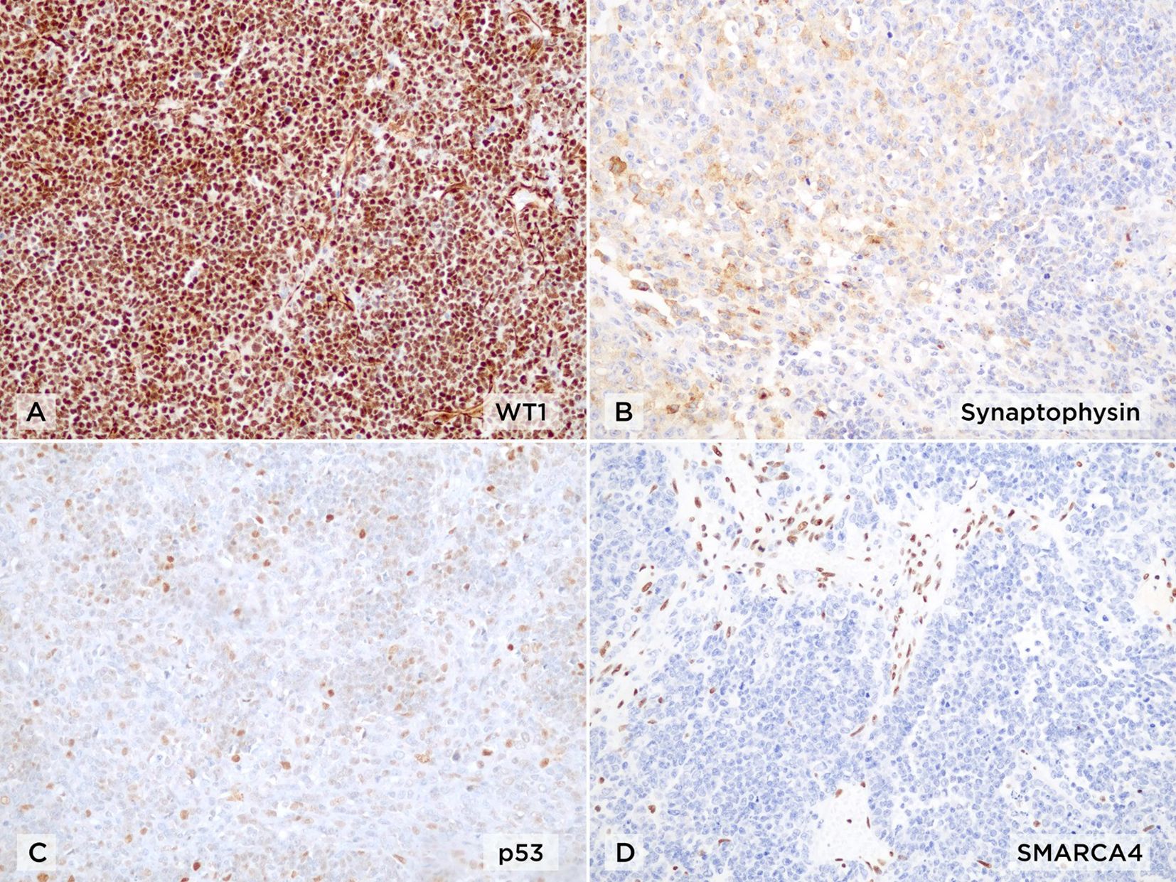 Histological image divided into four panels showing immunohistochemical staining patterns. Panel A highlights WT1 staining with a dense, dark pattern. Panel B shows Synaptophysin with scattered brown staining. Panel C features p53 with light, sparse staining. Panel D displays SMARCA4 with distinct brown nuclei against a lighter background.