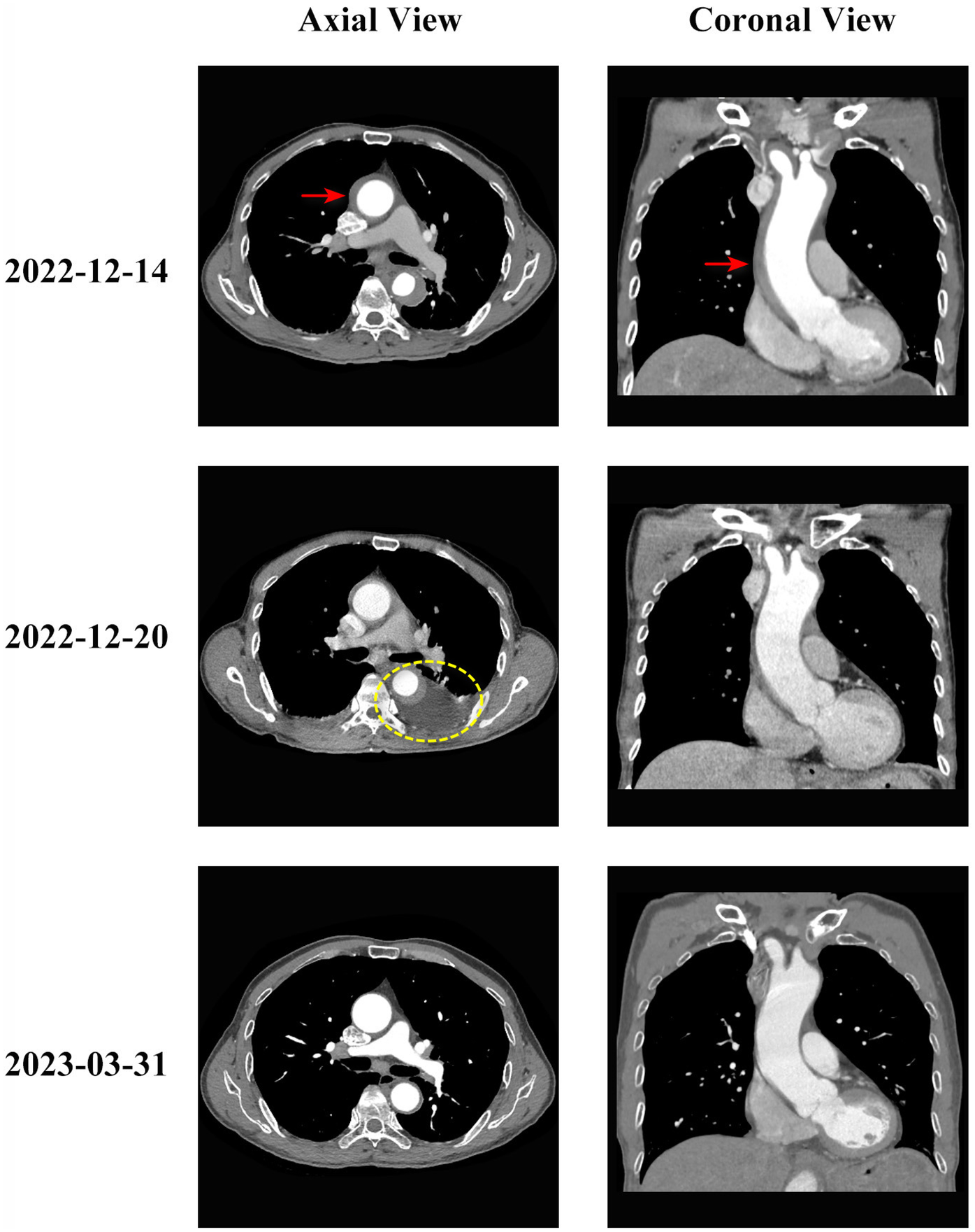 CT scan images showing axial and coronal views of a thoracic region on three dates: December 14, 2022, December 20, 2022, and March 31, 2023. December 14 images highlight an area with a red arrow, and December 20 images have a yellow dashed circle indicating a specific region. March 31 images show no highlighted areas.