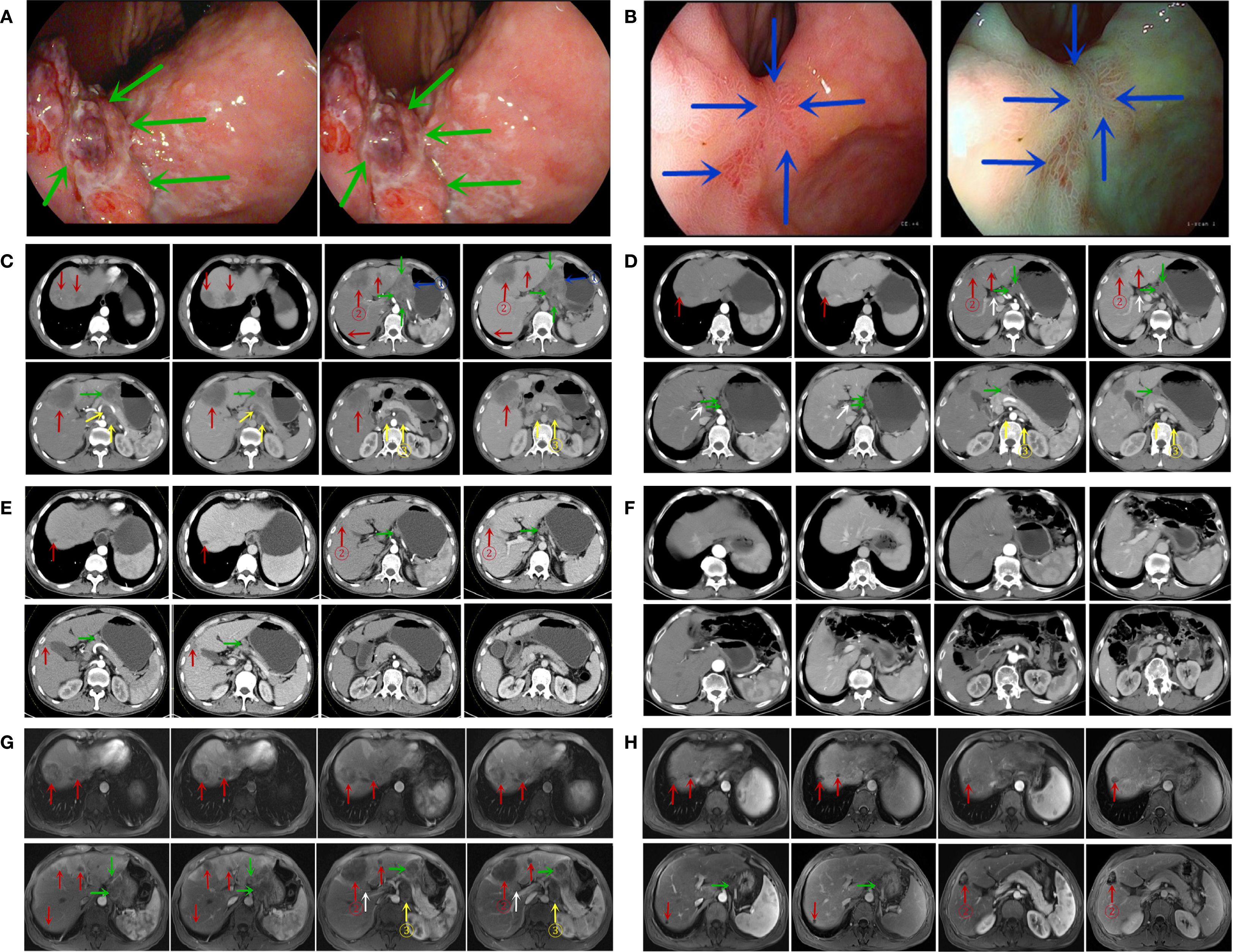 A series of medical images with labeled arrows indicating areas of interest. Panels A and B display endoscopic views, with green and blue arrows highlighting specific regions. Panels C to H show various CT and MRI scans, with colored arrows (red, green, yellow, and white) pointing to anatomical structures or abnormalities, suggesting a comparison or examination of health conditions across different imaging modalities. Each panel presents images in a grid format, indicating multiple views or slices for detailed analysis.