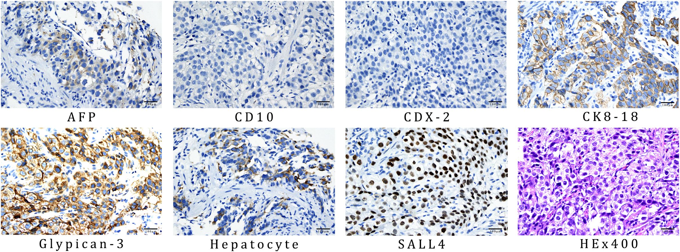 Eight microscopic images show tissue samples stained for different markers: AFP, CD10, CDX-2, CK8-18, Glypican-3, Hepatocyte, SALL4, and an HE stain at 400x magnification. Each panel highlights variations in cell structure and staining intensity.