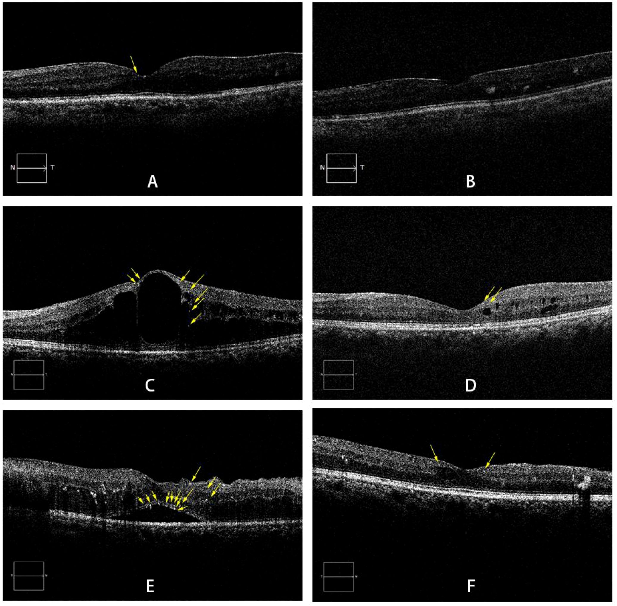 Optical coherence tomography (OCT) images A to F present cross-sectional views of retinal layers. Yellow arrows highlight specific features or irregularities in each image, such as fluid accumulation or layer disruptions, indicating varying stages or conditions of retinal health.