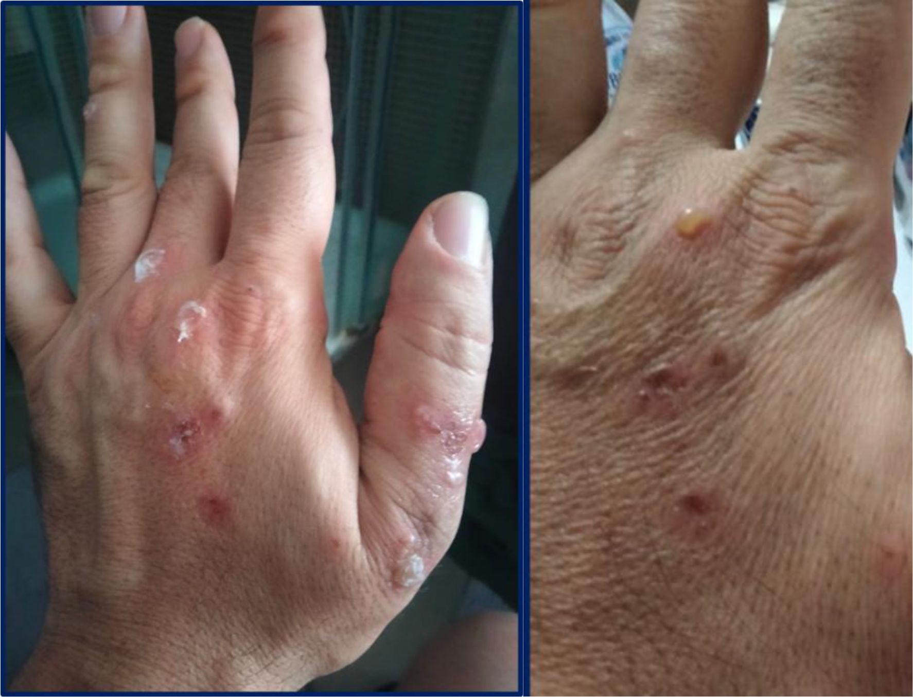 Close-up images of a hand showing multiple skin lesions on the back and the knuckles. The skin appears irritated in some areas, with visible redness and blisters.
