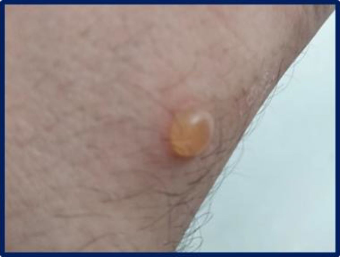 Close-up of a small, fluid-filled blister on the skin. The blister is raised, round, and translucent. The surrounding skin is lightly pigmented.