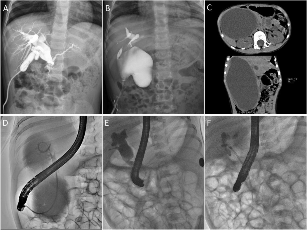 A series of medical images showing different diagnostic views. Panel A and B display X-rays of the abdomen with contrast highlighting the biliary tree. Panel C presents two CT scans of an abdominal lesion, with axial and sagittal views. Panels D, E, and F depict endoscopic retrograde cholangiopancreatography (ERCP) procedures, showing the insertion of an endoscope and contrast outlining the bile ducts.