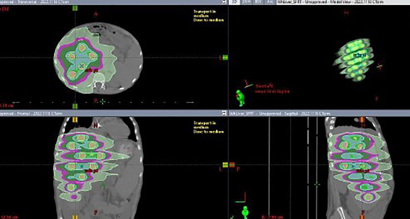 Medical imaging scans showing axial, sagittal, and coronal views of a human torso. The scans display color-coded regions highlighting specific dosimetric areas. Annotations and scales are visible, indicating technical details