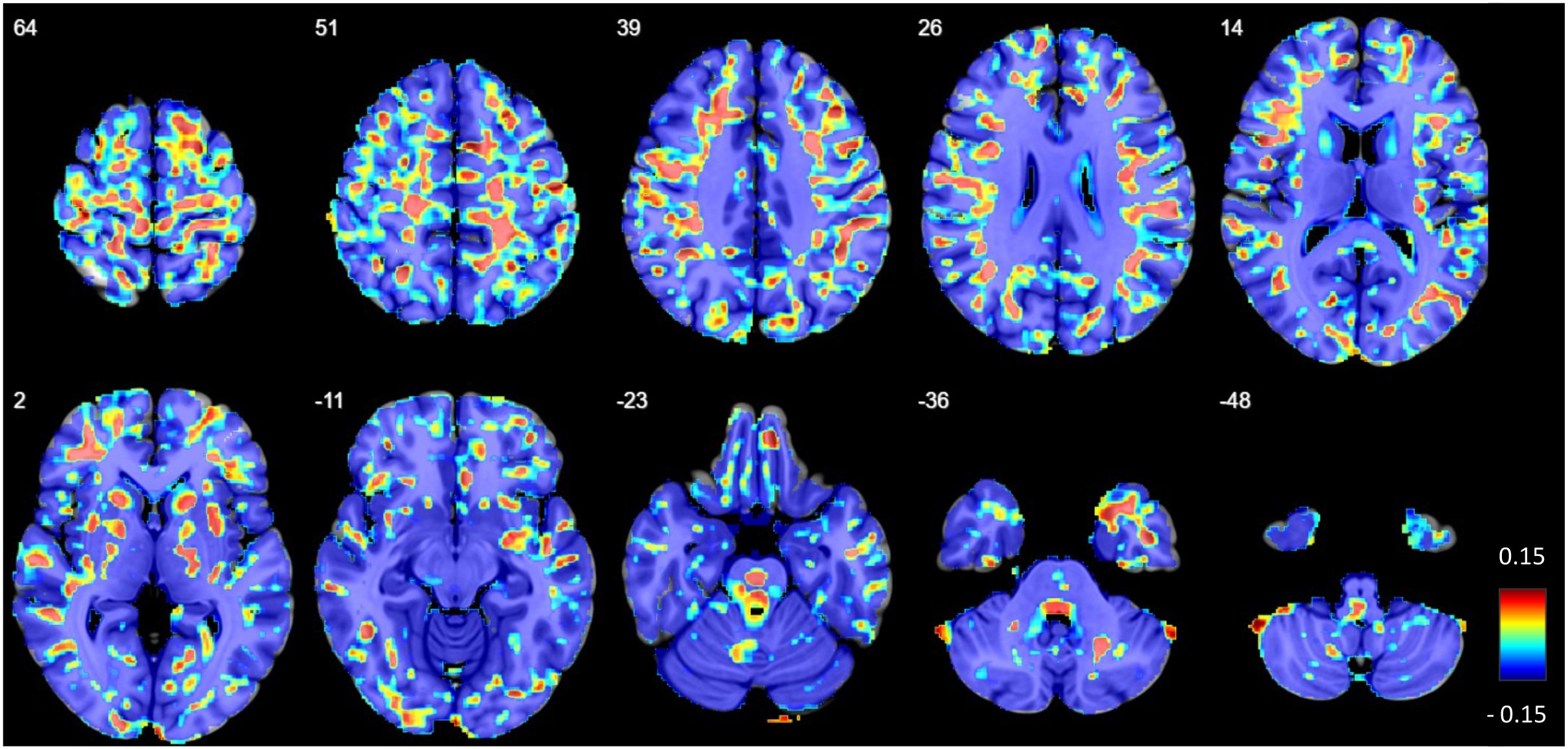Brain MRI scans display axial slices at various levels showing voxel-wise comparisons between patients with suspected autoimmune psychosis spectrum syndromes and healthy controls (hot colors: positive effects vs. cold colors: negative effects).