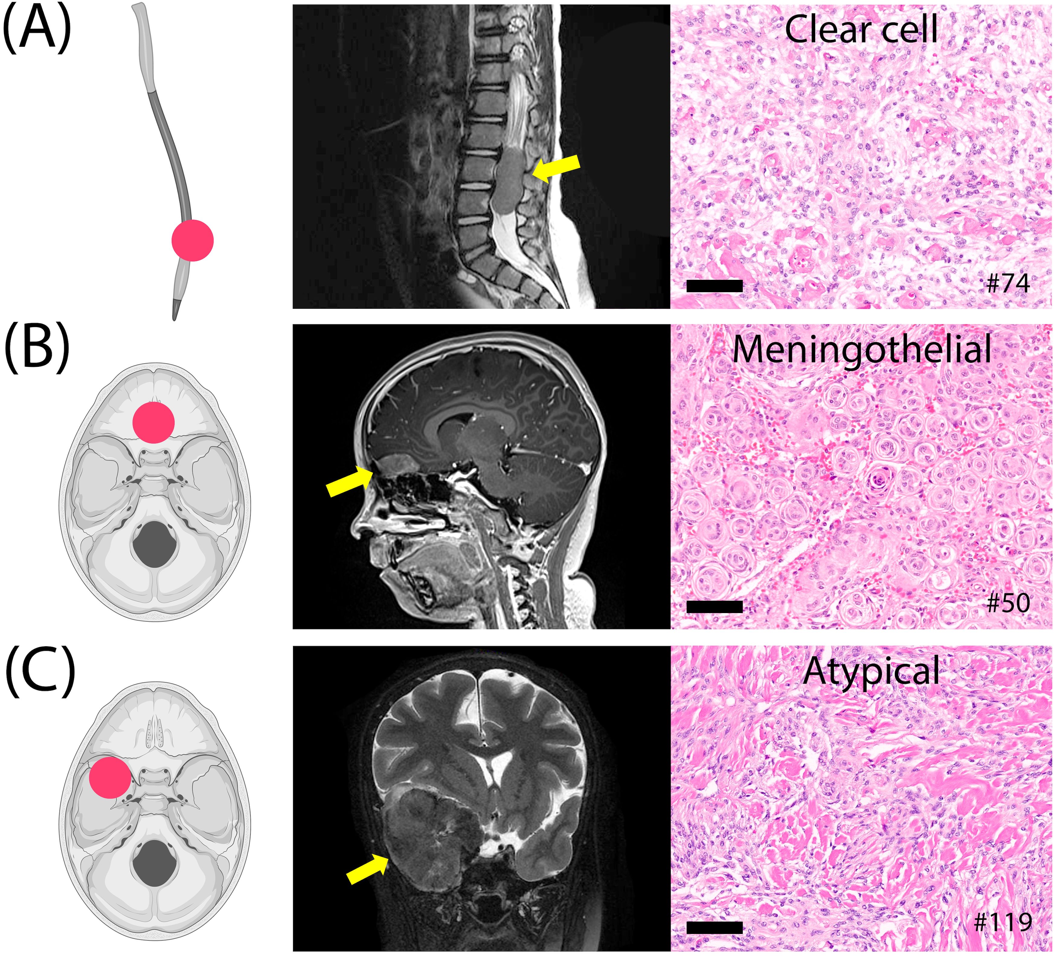 QDiagram showing three pediatric meningioma cases (A–C), each including an illustration with location (indicated by a red dot), MRI scan, and microscopic image. MRI scans feature yellow arrows pointing to the tumors. Microscopic images display distinct histologies: (A) clear cell, (B) meningothelial, and (C) atypical. Black scale bars are included in the microscopic views.