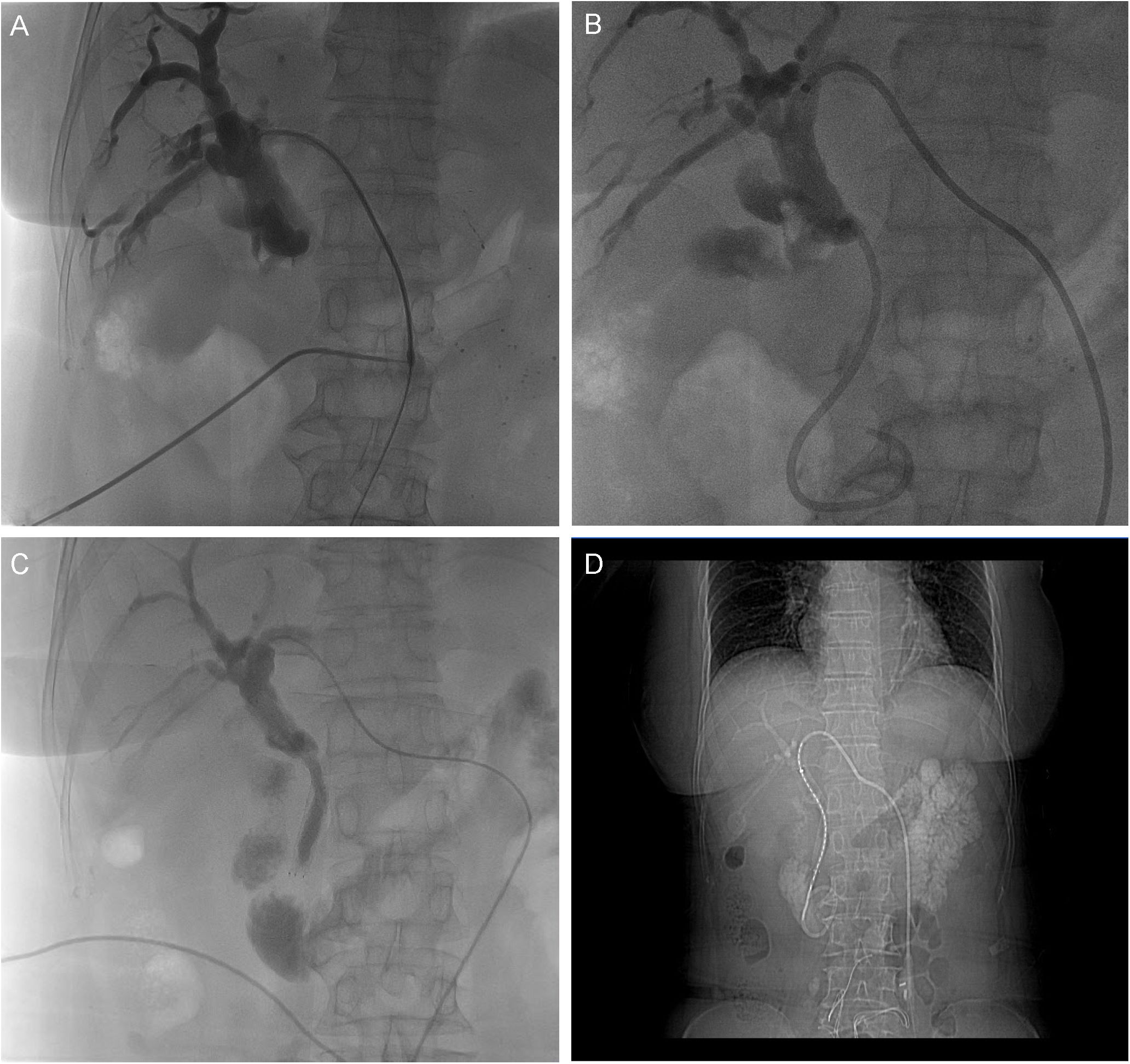Composite image with four panels showing radiographic scans. Panel A, B, and C display angiographic images with contrast highlighting blood vessels. Panel D shows a frontal X-ray capturing the chest and abdomen area, revealing skeletal and organ structures.