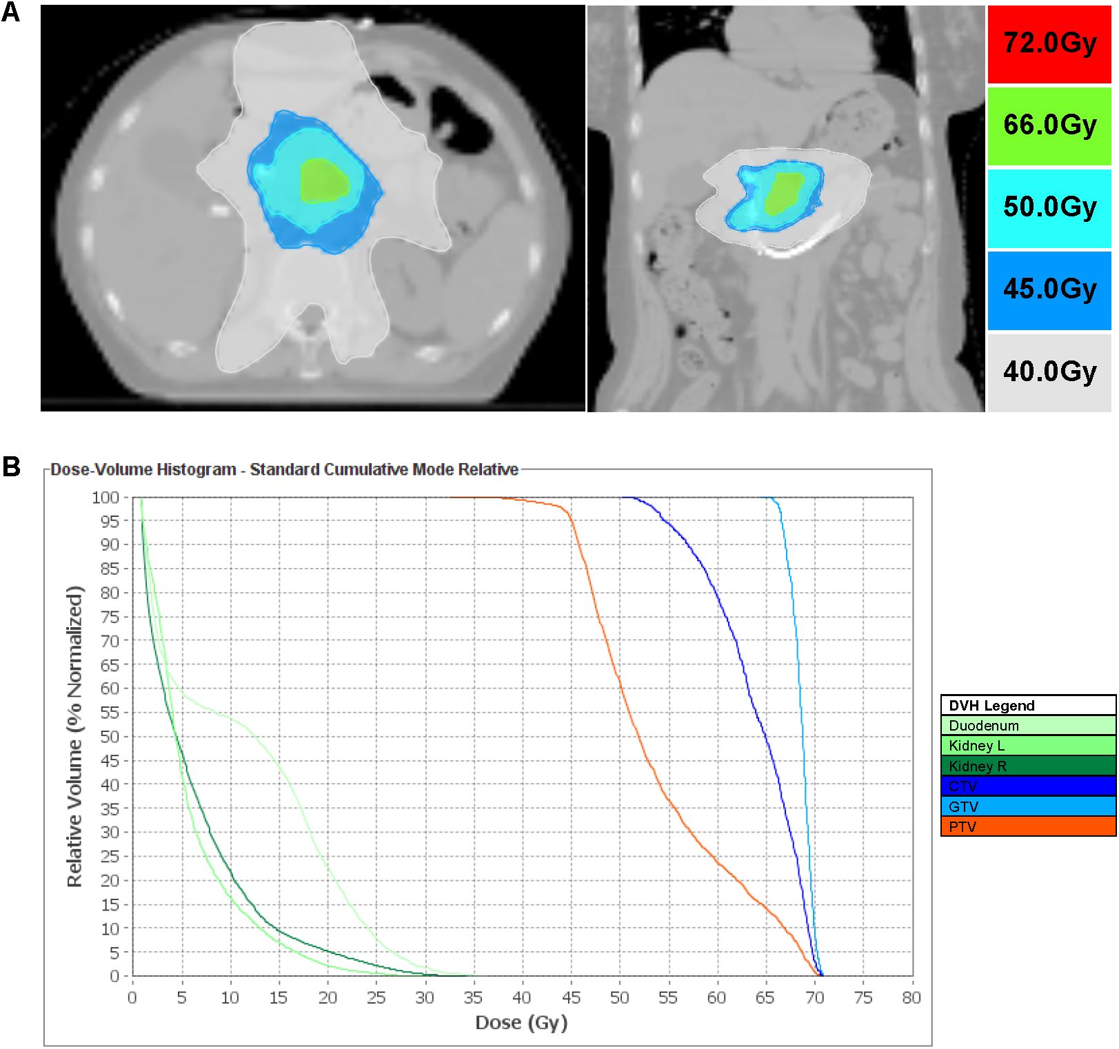 Medical image showing a radiotherapy dose distribution map on CT scans (top) with color-coded dose levels from forty to seventy-two Gray (Gy). Below, a Dose-Volume Histogram (DVH) shows relative volume versus dose for structures like the duodenum, kidneys, GTV, and PTV. Colors in the legend match the dose distribution, depicting the impact on different anatomical targets.