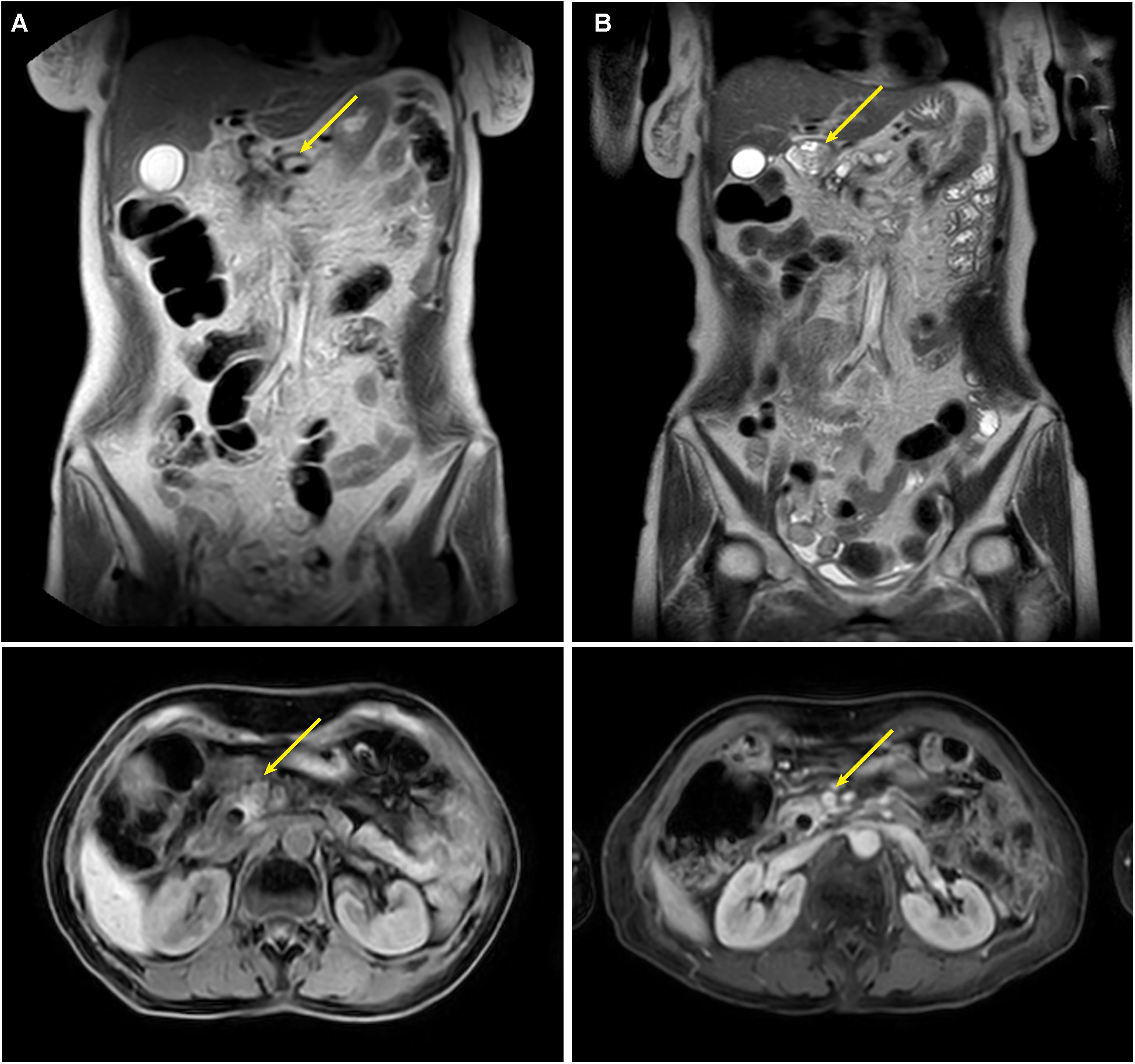 MRI scans show abdominal sections with yellow arrows indicating areas of interest. Top row displays coronal views (A and B) of the torso. Bottom row shows axial cross-sections of the abdomen. The scans highlight anatomical structures for medical evaluation.