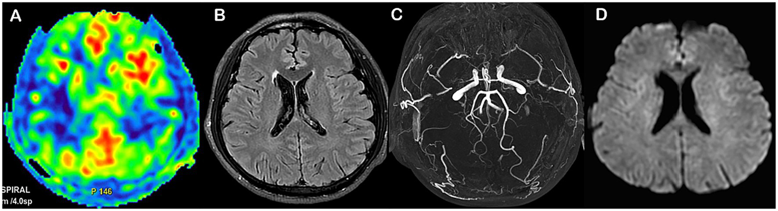 Four brain images labeled A to D. A shows a colorful cerebral perfusion image with red highlights indicating high activity areas. B displays a grayscale MRI scan with visible brain structures. C is a magnetic resonance angiography (MRA) showing vascular structures in white against a black background. D presents a diffusion-weighted imaging (DWI) scan showcasing the brain's structural details.