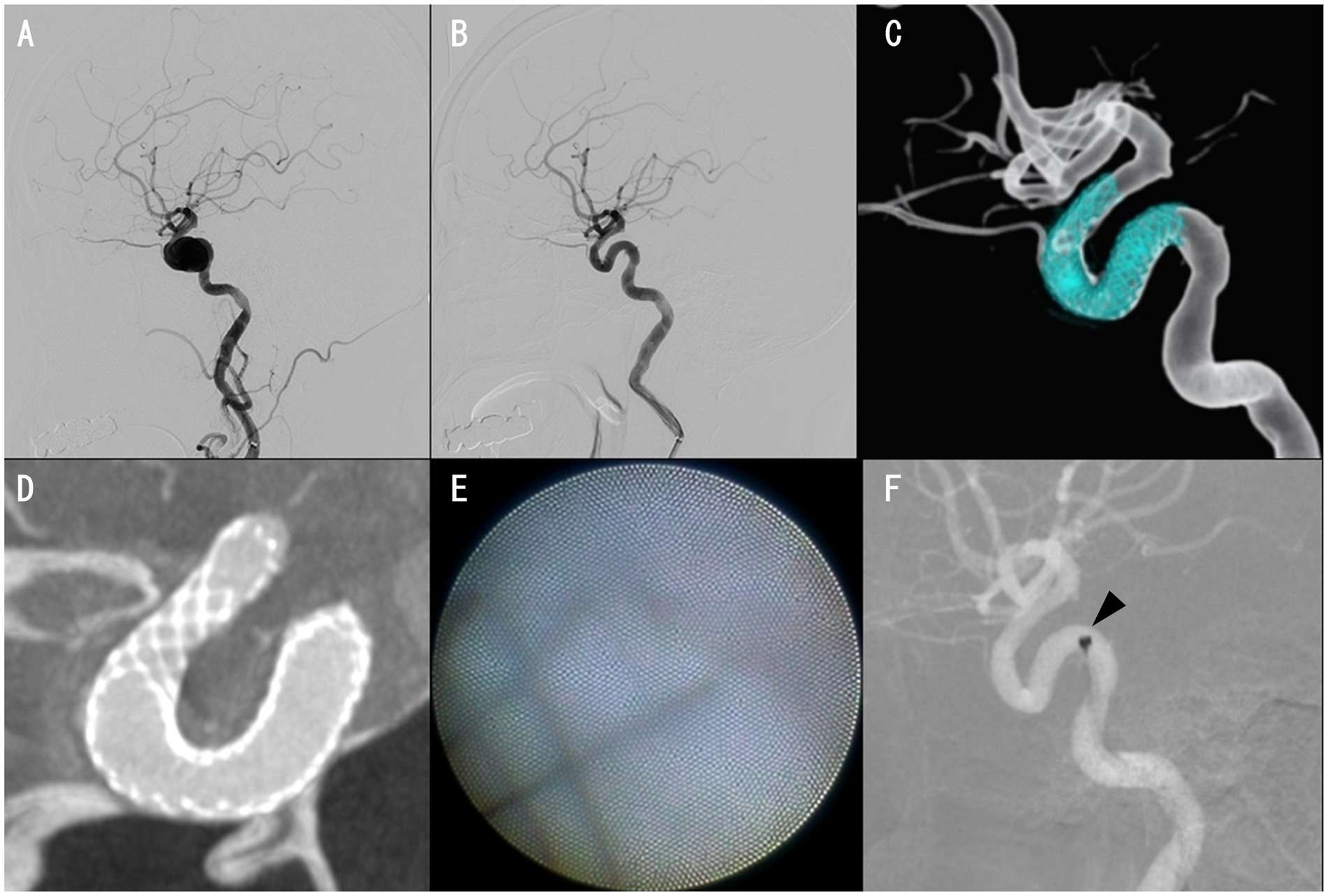 Medical images showing a series of angiographic views: A) An artery with a visible aneurysm. B) Post-treatment artery without an aneurysm. C) 3D reconstruction highlighting a stent placement. D) Close-up of the stent within the artery. E) Microscopic view of a mesh structure. F) Follow-up angiogram showing successful stent placement with a marked improvement.