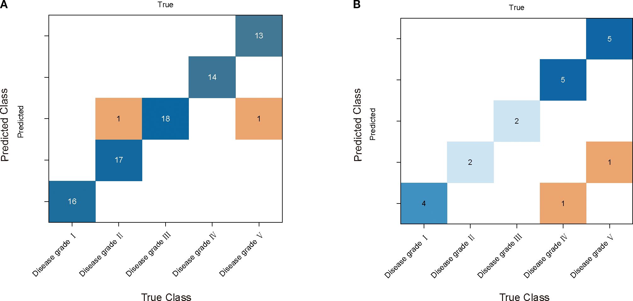 Two confusion matrices labeled A and B, showing the comparison between predicted and true disease grades I to V. Matrix A has strong predictions for grades III and V, with some misclassifications across grades II and IV. Matrix B shows more dispersed predictions with errors across grades, particularly in grade I, and stronger predictions for grades IV and V.