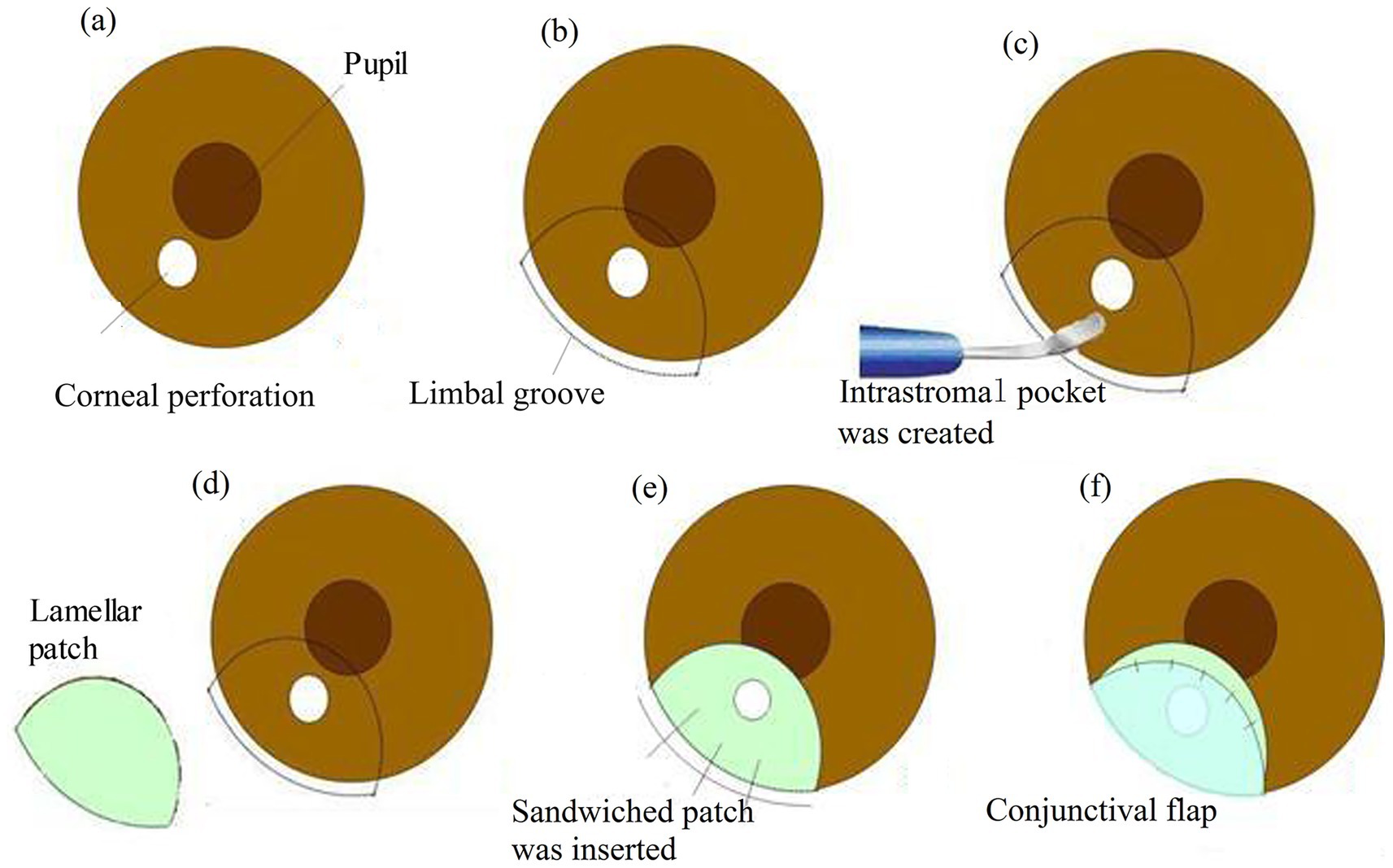 Diagram illustrating corneal surgery steps: (a) Corneal perforation near the pupil. (b) A limbal groove is made. (c) Formation of an intrastromal pocket with a tool. (d) Lamellar patch is prepared. (e) Sandwiched patch inserted into the cornea. (f) Completion with a conjunctival flap covering the patch.