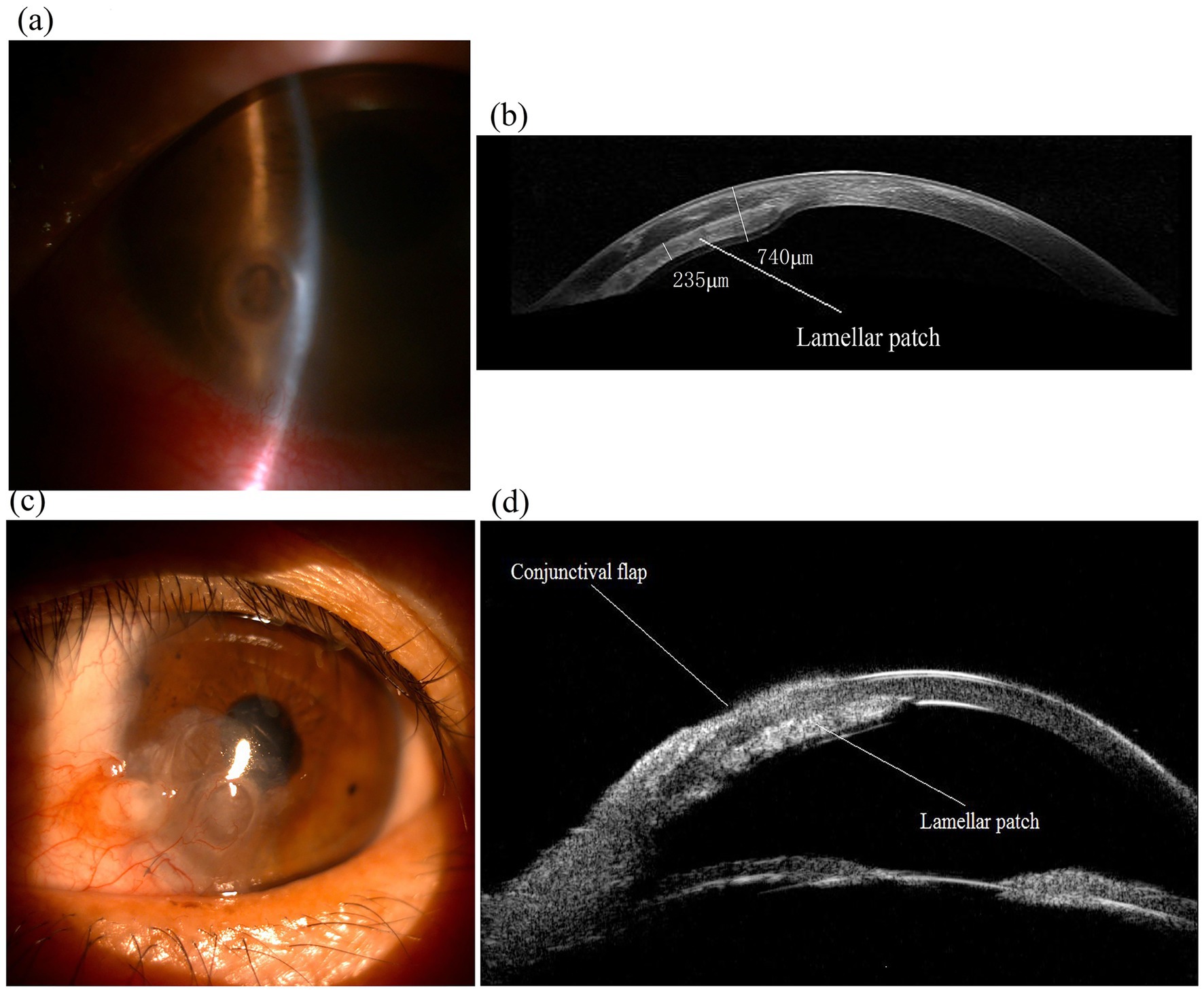 (a) Close-up photograph of an eye showing corneal curvature and reflection. (b) An optical image with measurements indicating a lamellar patch, showing thickness dimensions of 235 micrometers and 740 micrometers. (c) Close-up of an eye with visible vessels and opacity in the cornea. (d) Optical image labeled with a conjunctival flap and lamellar patch, illustrating the structural details of the eye.