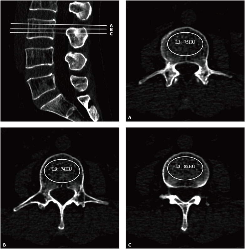 CT scan images showing lumbar vertebrae in different views. The left image displays a sagittal view with lines indicating levels A, B, and C. The right images, labeled A, B, and C, show axial views of the L3 vertebra. The images display Hounsfield units (HU) within the vertebra: 75 HU for A, 74 HU for B, and 82 HU for C.