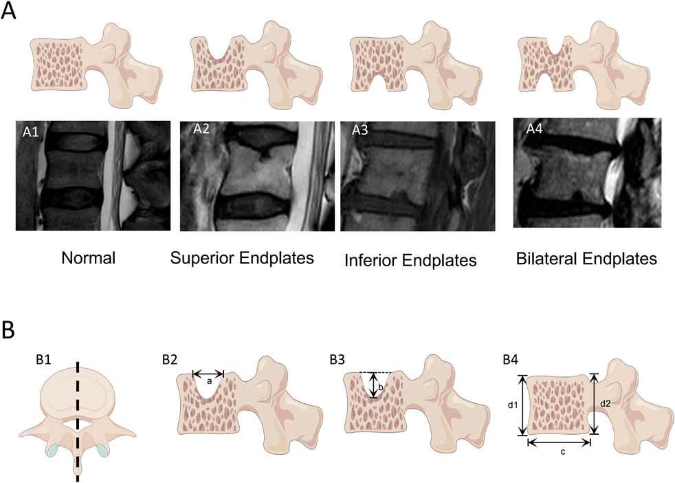 Illustrations and MRI images depicting vertebral endplates. Part A shows MRIs: A1 is a normal endplate, A2 illustrates superior endplate changes, A3 shows inferior endplate changes, and A4 displays bilateral endplate changes. Part B contains diagrams: B1 shows a vertebra cut line, B2 measures indentation width (a), B3 measures indentation depth (b), B4 shows dimensions of vertebral widths (c, d1, d2).