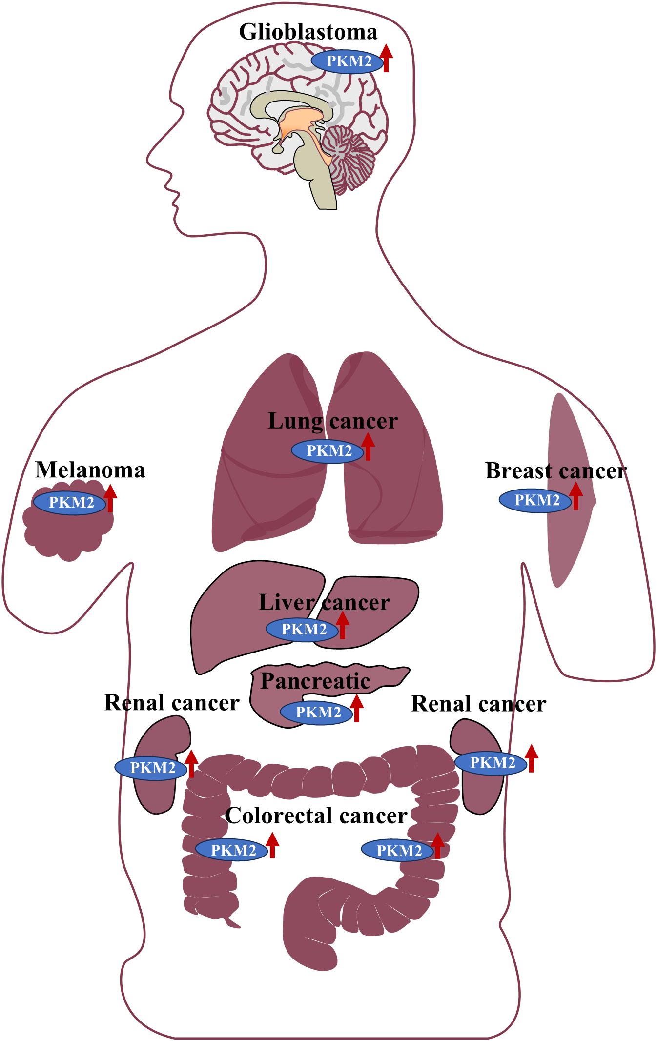 Diagram of a human outline with various cancers labeled: glioblastoma in the brain, lung, melanoma, breast, liver, pancreatic, renal, and colorectal cancers. All labels are accompanied by “PKM2” with an upward arrow, indicating increased expression.