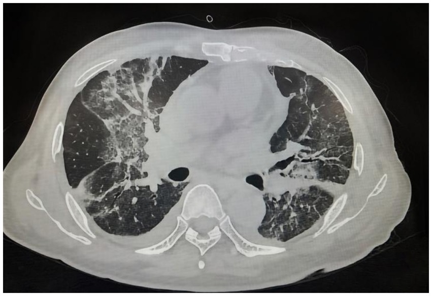 CT scan of a chest showing extensive white areas indicating abnormal tissue patterns in both lungs, suggesting possible lung disease or damage. The scan is in a transverse section, highlighting internal structures.