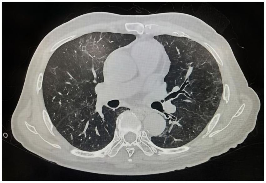 CT scan of the chest showing a transverse cross-section of the thorax. Visible are the lungs on either side, heart centrally located, vertebrae, and ribs. The lungs appear mostly clear with no obvious masses.