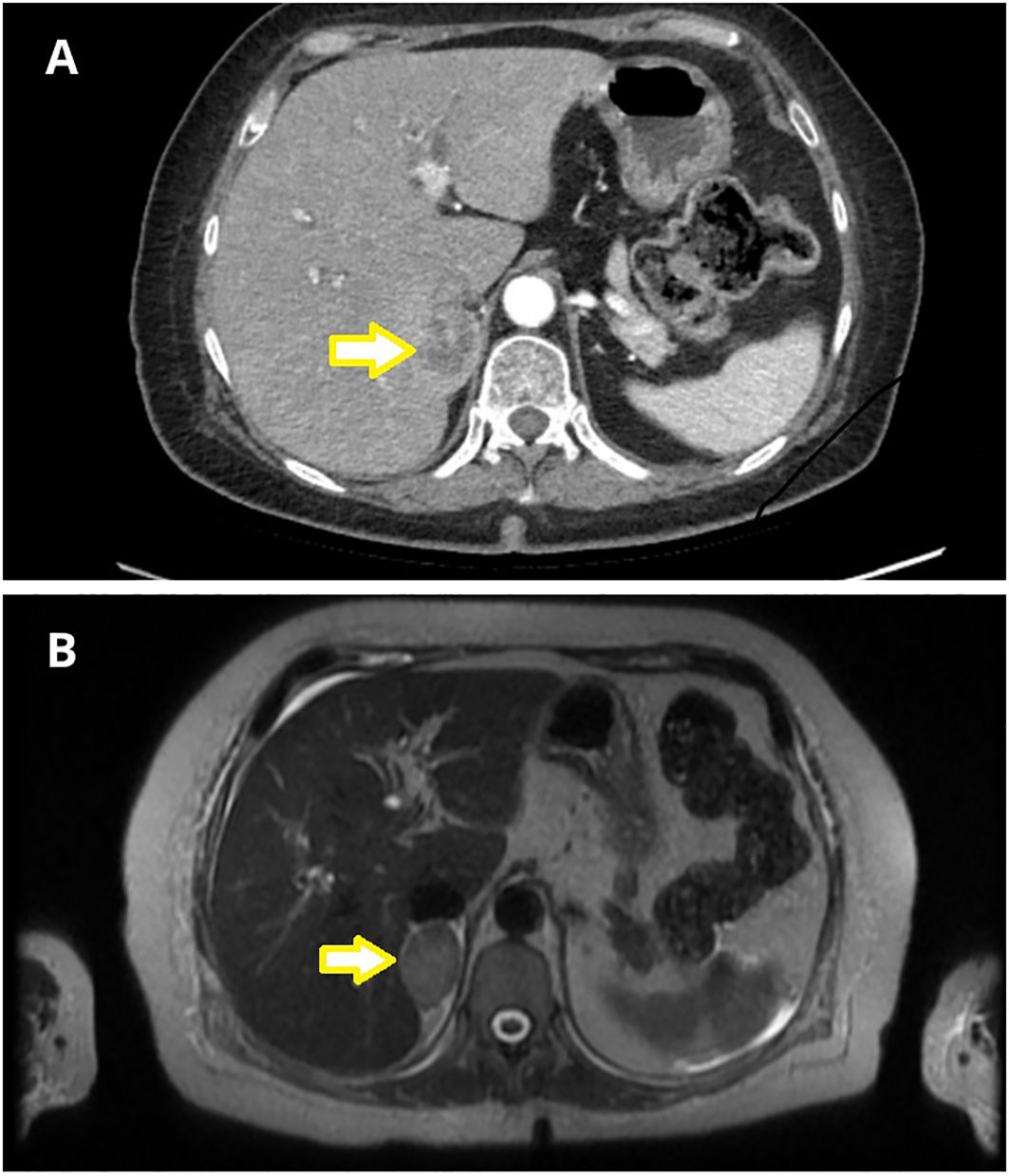 Medical imaging of an adrenal mass (NOT LIVER). Section A shows a CT scan with a yellow arrow indicating the lesion near the spine, adjacent to the right adrenal gland. Section B presents a corresponding MRI scan, with the yellow arrow pointing to the same region for comparison.