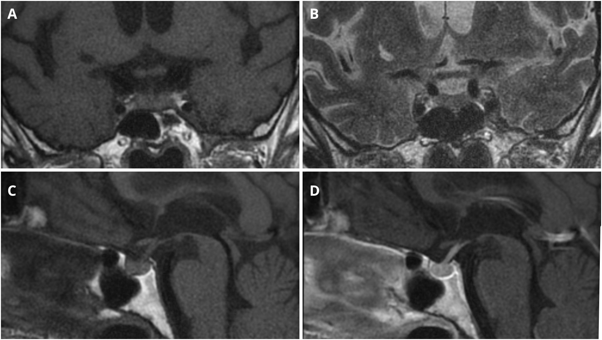 Four panel pituitary MRI images labeled A, B, C and D. A) Coronal T1-weighted sequence. B) Coronal T2-weighted sequence. C) Sagittal T1-weighted sequence before intravenous contrast administration. D) Sagittal T1-weighted sequence after intravenous contrast administration.