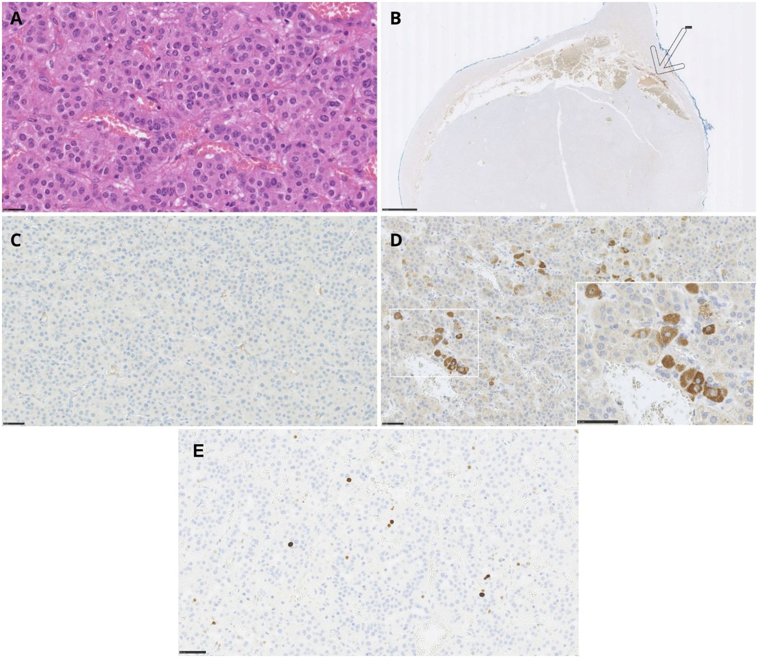 Histological and immunohistochemical images of an adrenal cortical adenoma. Panel A shows H&E staining of the tumor. Panel B presents negative chromogranin A staining in the tumor, with a positive signal in the adrenal medulla indicated by an arrow. Panel C shows negative ACTH staining. Panel D displays positive CRH expression in tumor cells, with an inset for detail. Panel E shows Ki-67 immunostaining of the tumor. Each panel includes a scale bar indicating magnification.