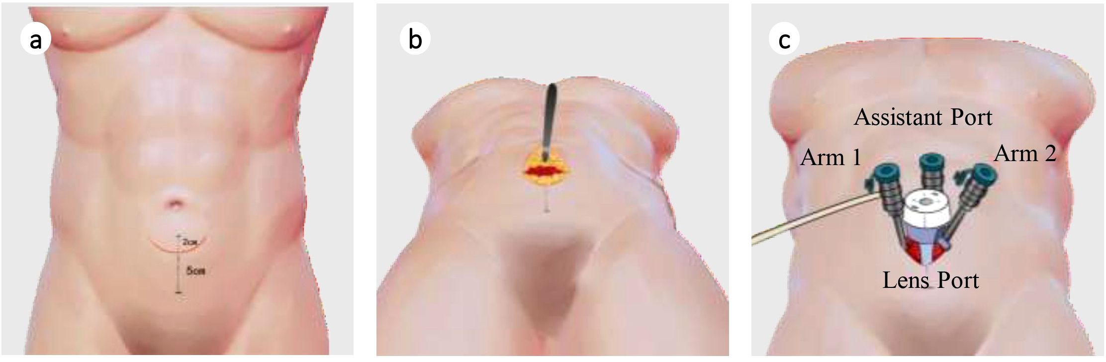 Diagram showing a three-step laparoscopic procedure. Panel a: Abdominal area with markings for incision location. Panel b: Insertion of a laparoscopic tool near the navel. Panel c: Trocar ports labeled as Assistant Port, Arm 1, Arm 2, and Lens Port for surgical access.