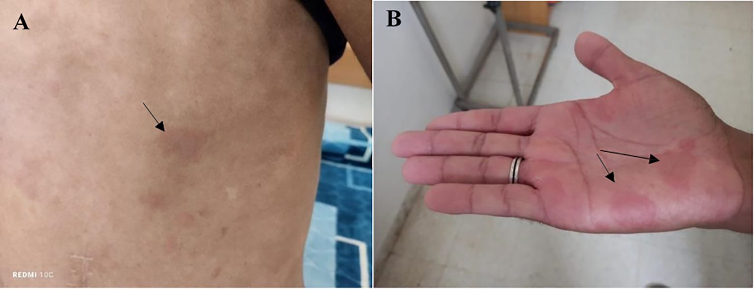 Two clinical images labeled A and B showing cutaneous lesions. Image A displays the torso with papular, erythematous, and edematous lesions arranged in an annular pattern. Image B depicts the palm of a hand with multiple reddish, urticarial patches. Arrows in both images highlight the affected areas.