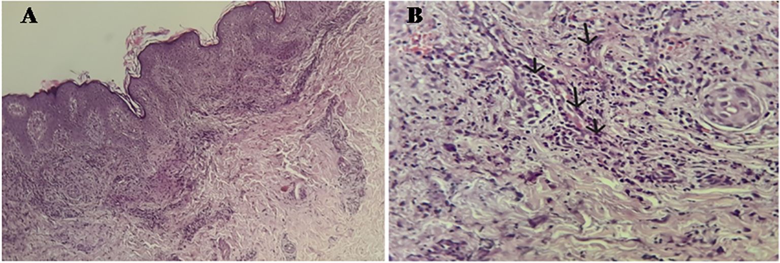 Histopathological features of skin biopsy. (A) Hematoxylin-Eosin stain, ×10: Layered epithelial tissue with dense perivascular inflammatory infiltrate in the dermis and subcutaneous tissue, including lymphocytes and plasmacytes, without neutrophilic dermatosis. (B) Hematoxylin-Eosin stain, ×40: Connective tissue showing swelling of vessel walls and t ransmural infiltration of neutrophils (black arrows), nuclear debris, and erythrocyte extravasation consistent with leukocytoclastic vasculitis.
