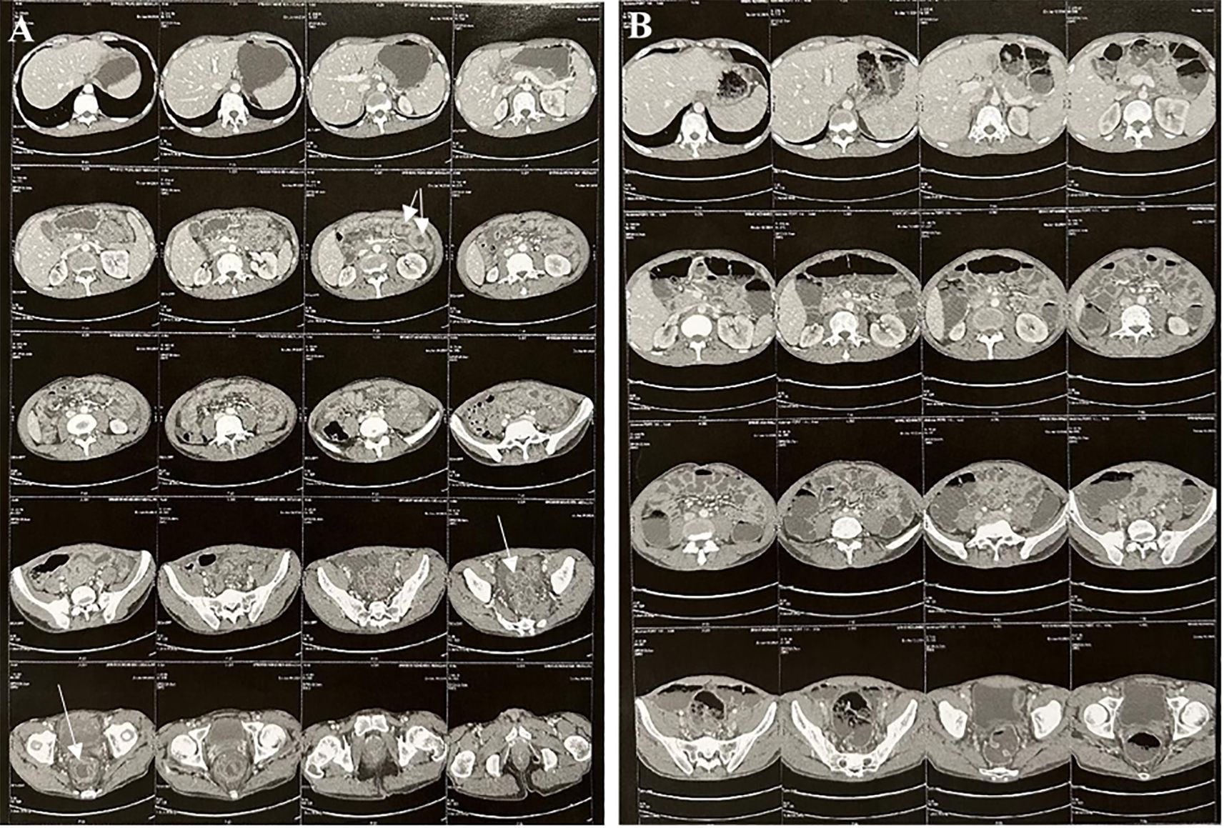 Two columns of abdominal CT scan images labeled A and B. Column A shows sequential cross-sections during the acute phase, with symmetric thickening of the rectosigmoid and proximal jejunal walls, visible submucosal and mucosal edema, and enhanced mucosal lining forming an “accordion sign.” Moderate free fluid is also present in the abdominal cavity. Column B displays follow-up scans showing complete resolution of the previous bowel wall thickening. Arrows highlight areas of interest in both sets of images.