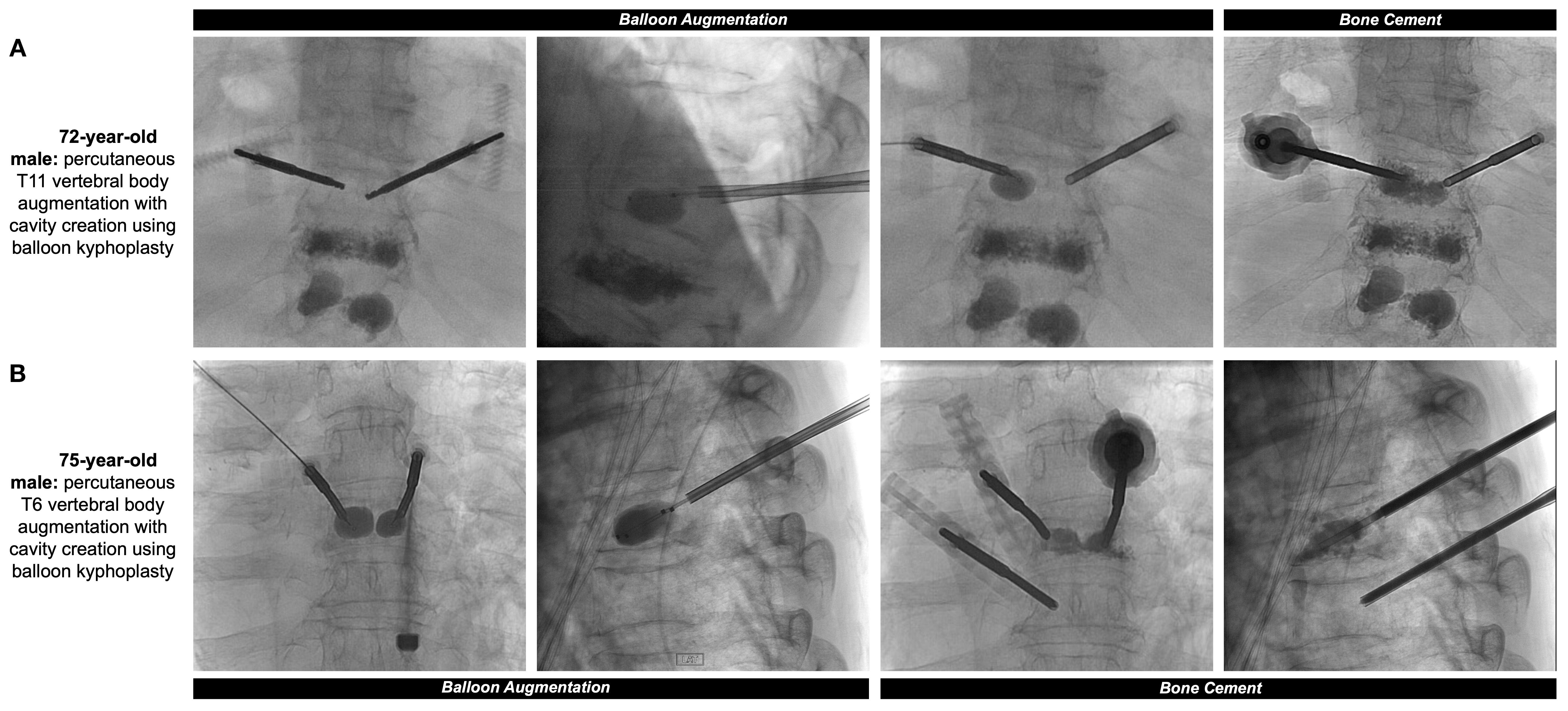 X-ray images showing balloon kyphoplasty procedures on the T11 vertebral body of a seventy-two-year-old male and the T6 vertebral body of a seventy-five-year-old male. The images depict balloon augmentation and bone cement application.