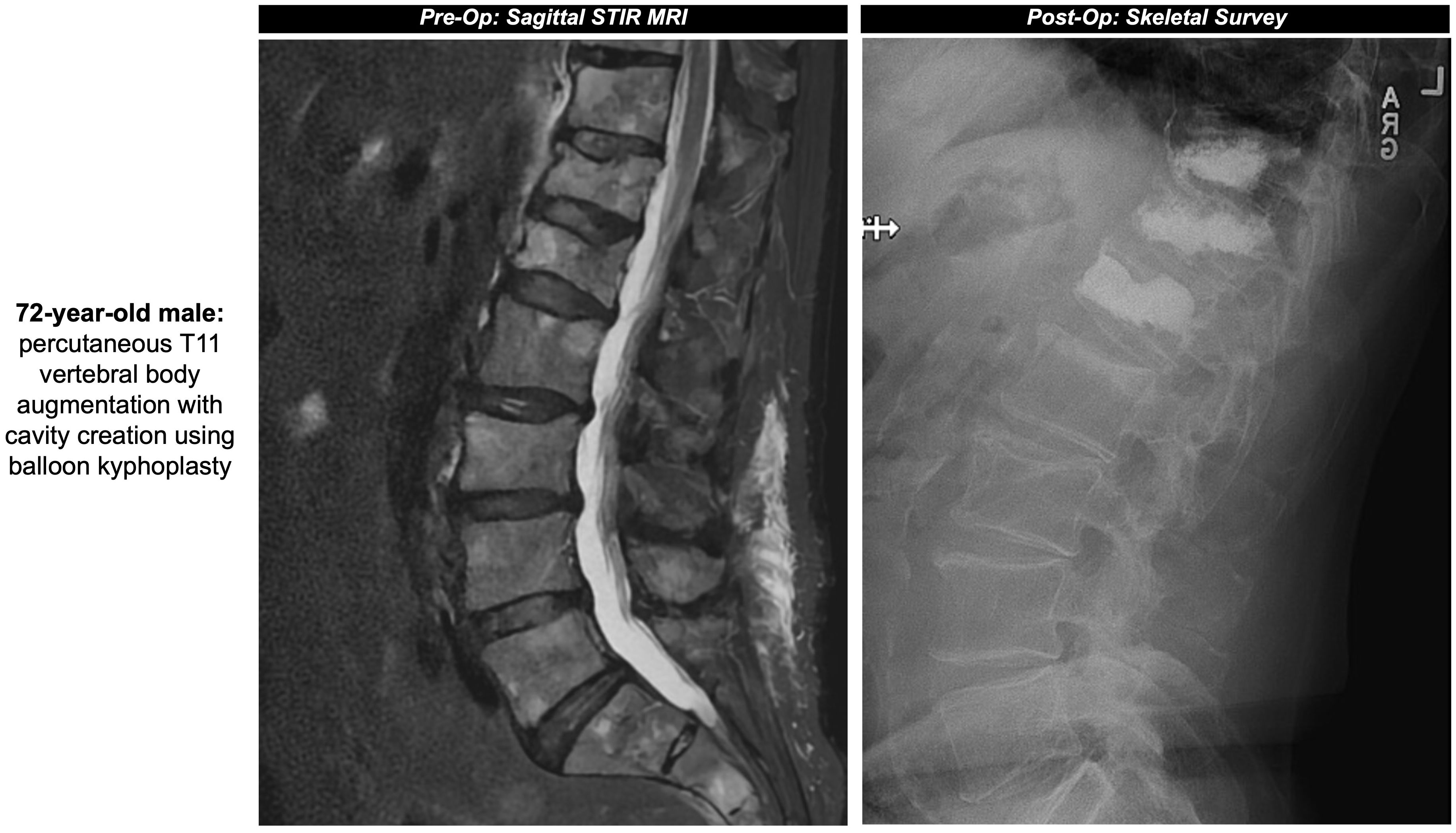 Pre-operative sagittal STIR MRI shows the spinal column, highlighting the T11 vertebra. Post-operative skeletal survey X-ray demonstrates the same region after balloon kyphoplasty, indicating changes in the T11 vertebra. Image text notes a 72-year-old male patient.