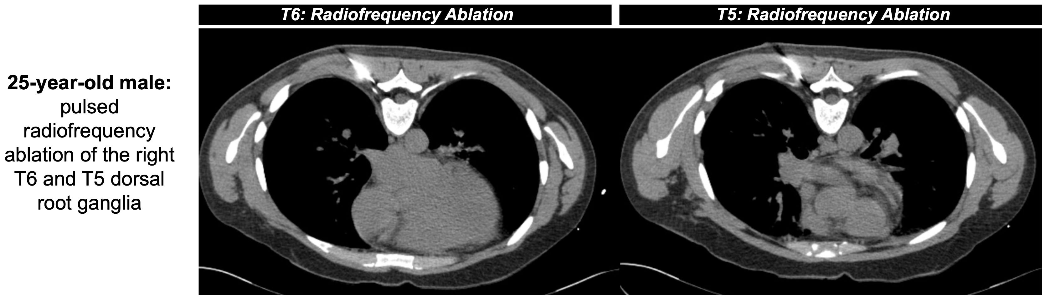 Two axial CT scans show the effects of pulsed radiofrequency ablation on the right T6 and T5 dorsal root ganglia of a 25-year-old male. The left image is labeled “T6: Radiofrequency Ablation” and the right image “T5: Radiofrequency Ablation,” depicting changes in the thoracic region.