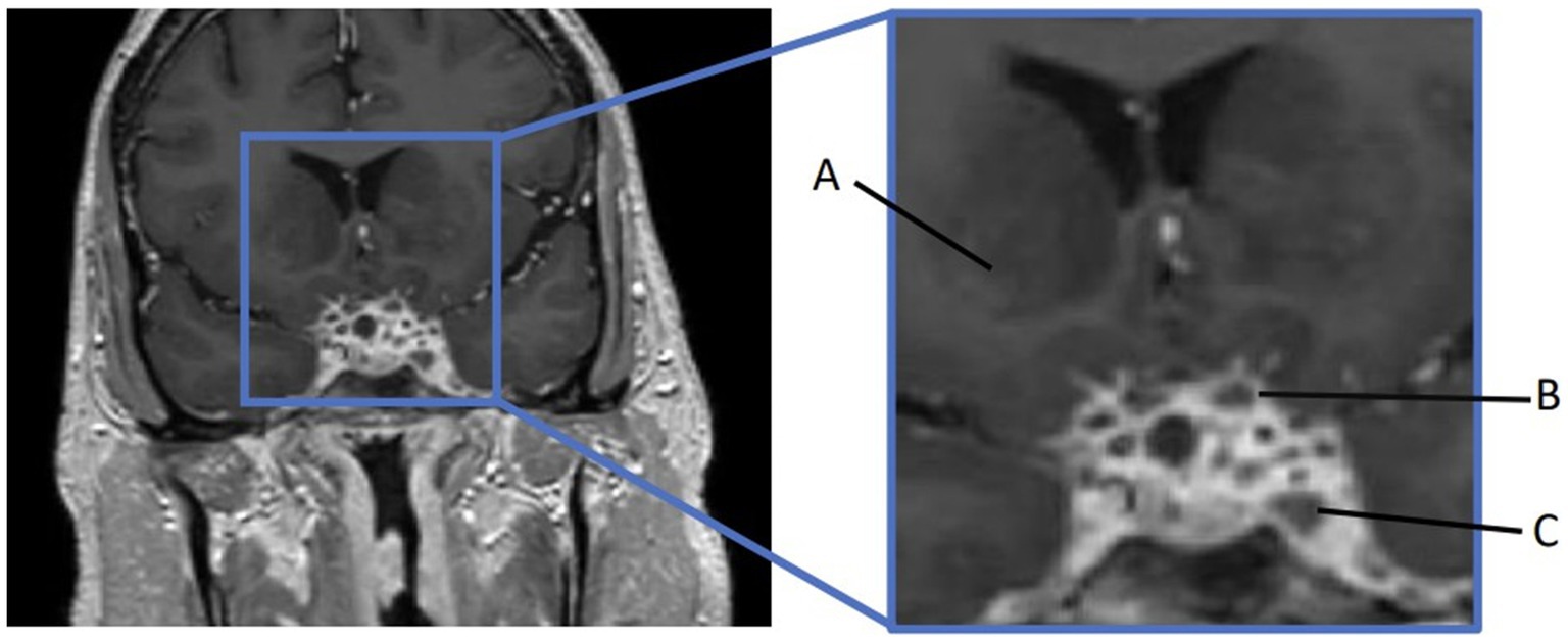 MRI scan showing a cross-section of the human brain with an enlarged area highlighted. The zoomed-in section is labeled A, B, and C, indicating specific regions or structures within the brain.
